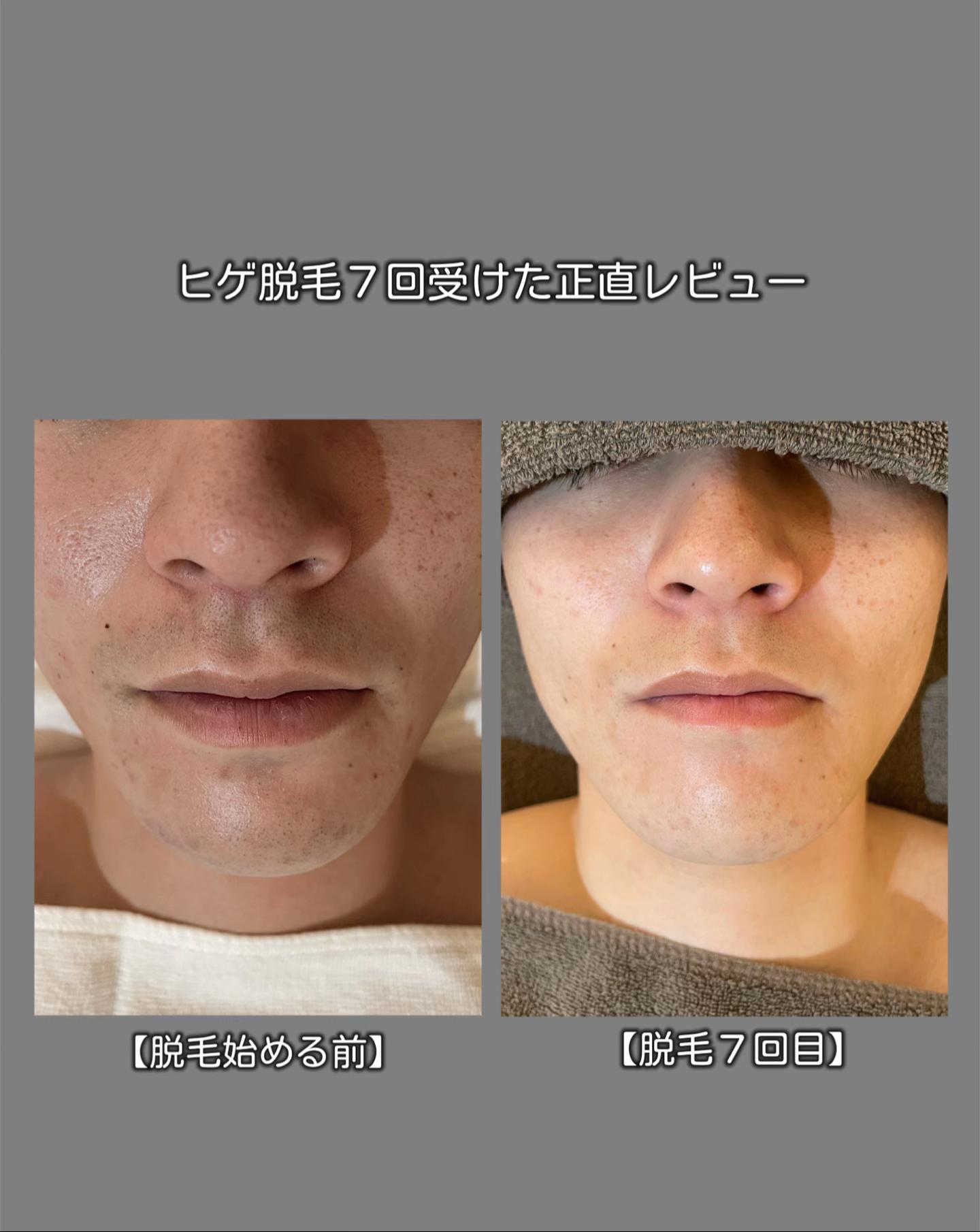 @メンズ脱毛サロンsilkymen’s札幌