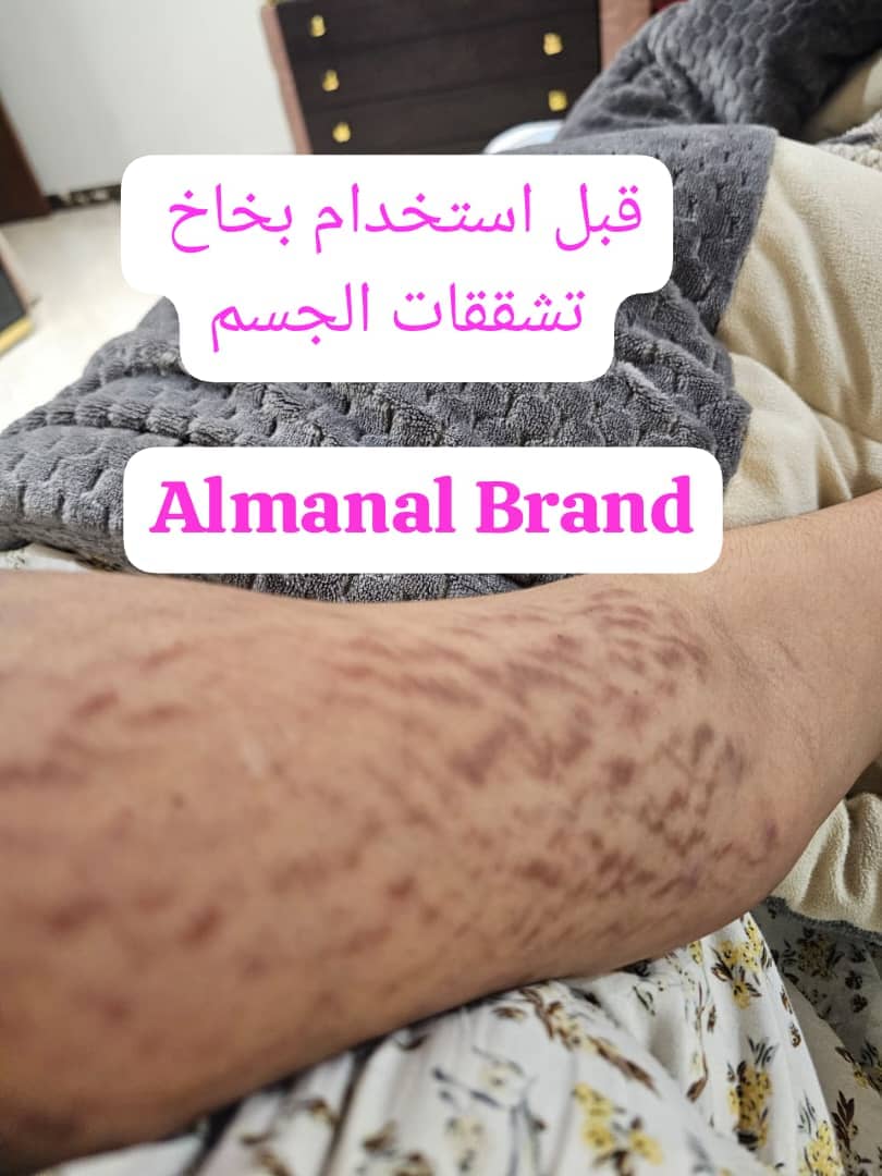 @drmanal " لعلاج التشققات "