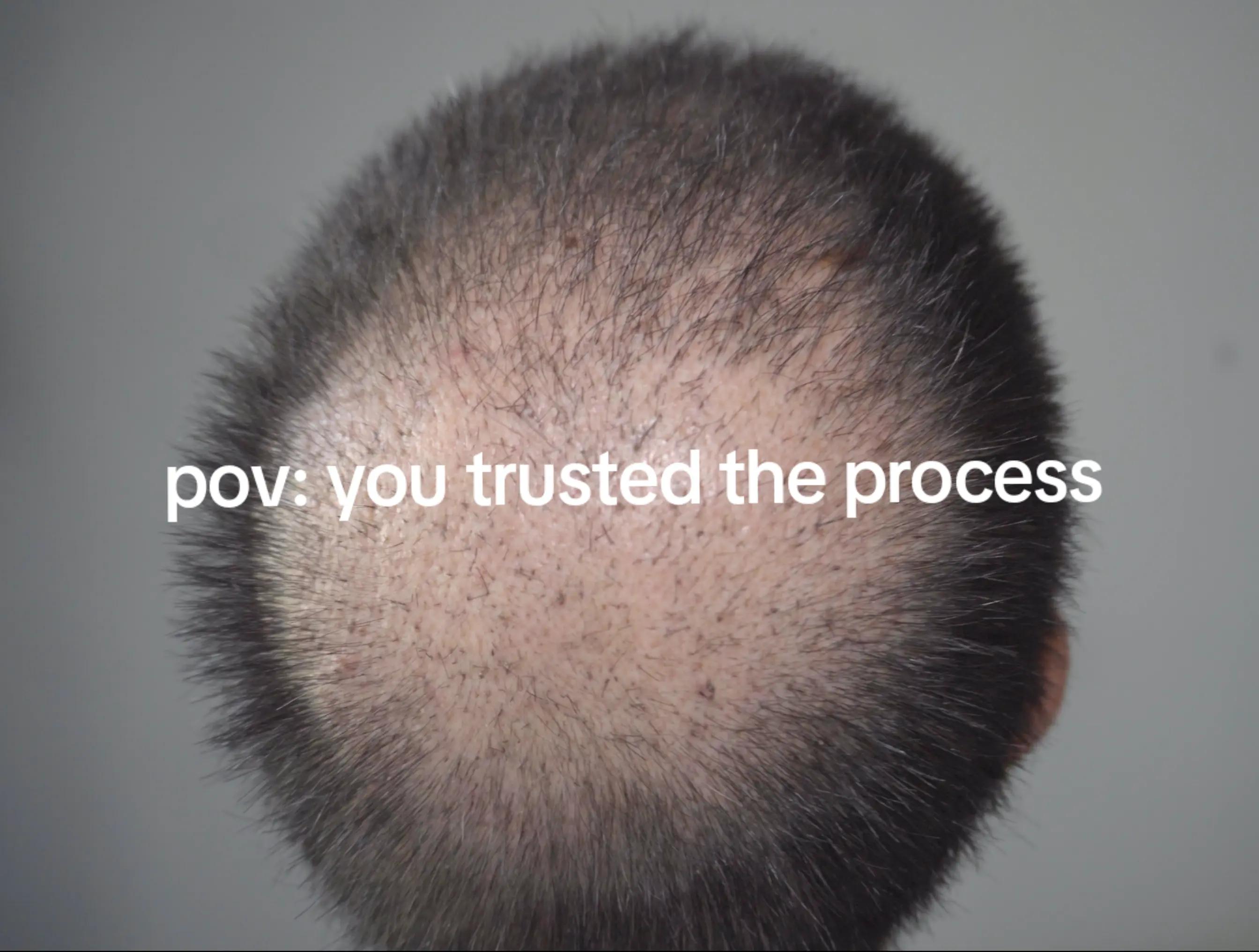 @Amit | Hair Transplant Tips