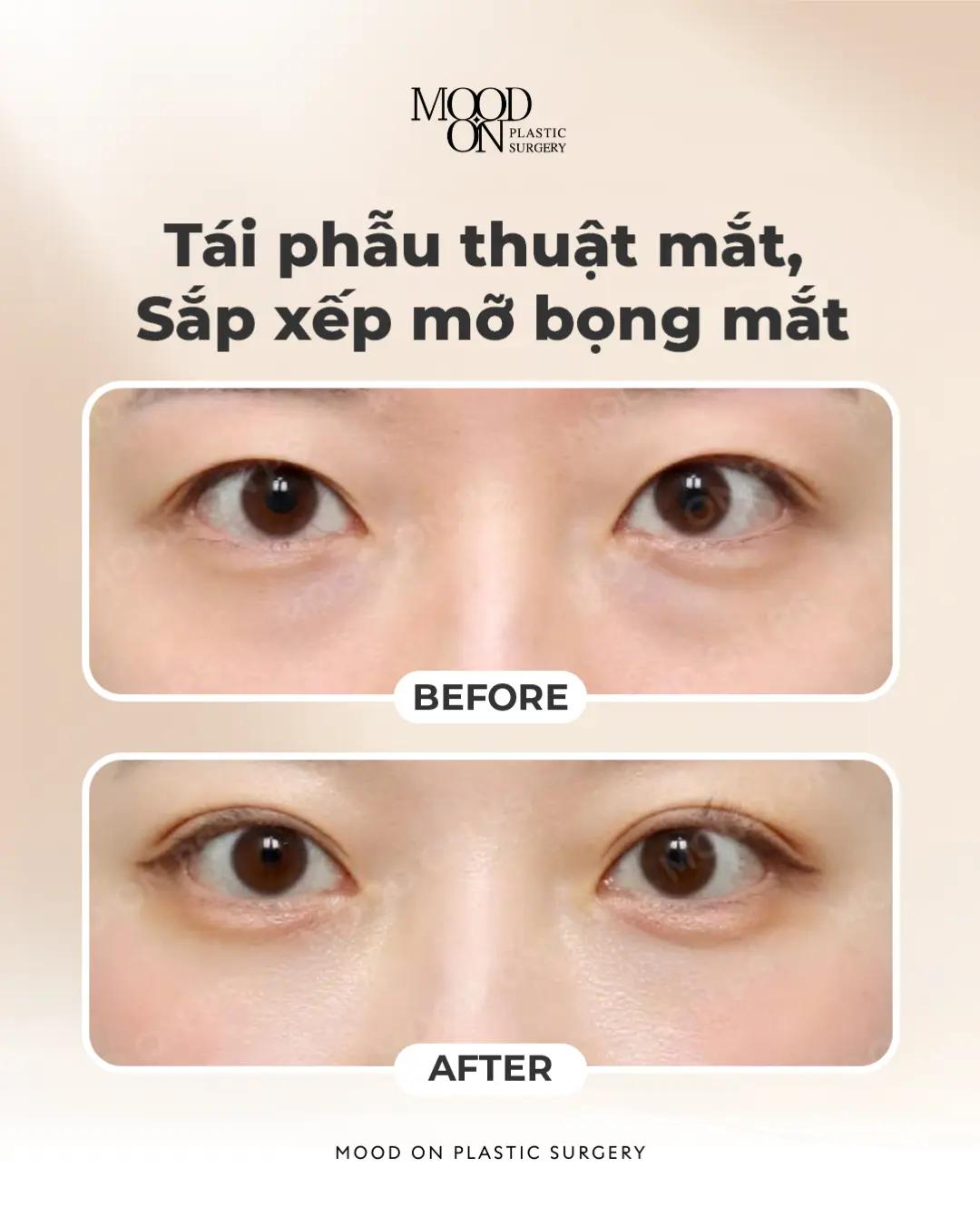 @Bệnh viện thẩm mỹ Mood On