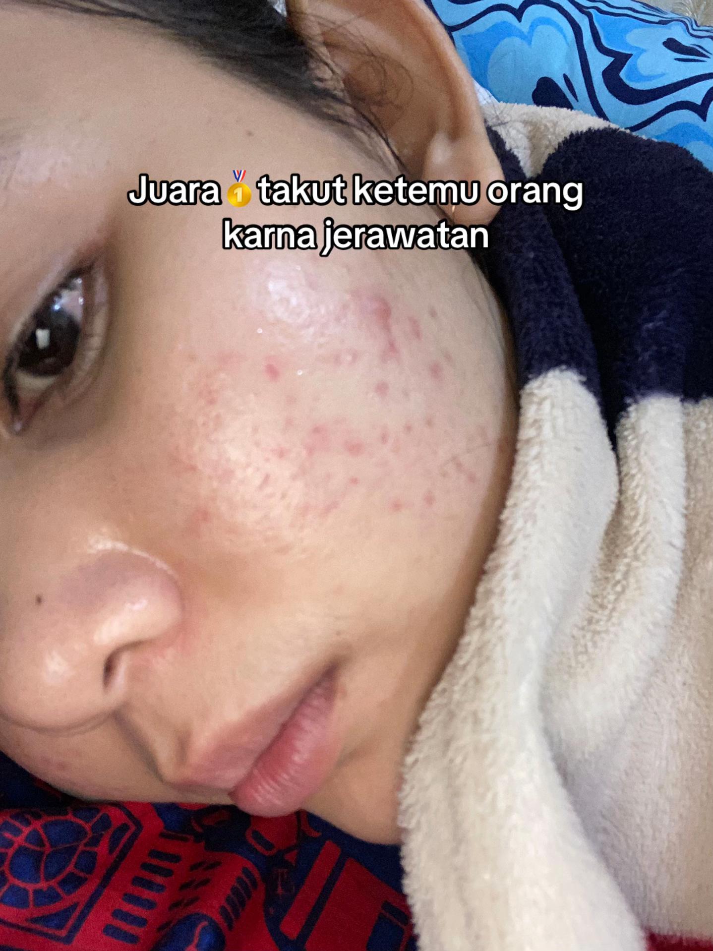 @Natha | Acne fighter