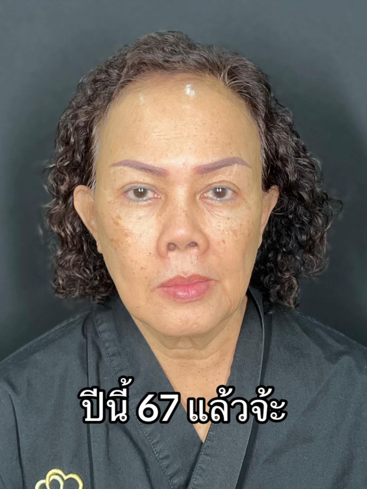 @ดึงหน้า ud clinic