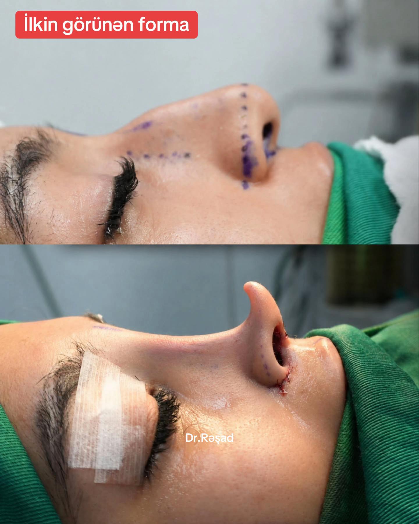 @rinoplastika_lor.cerrah