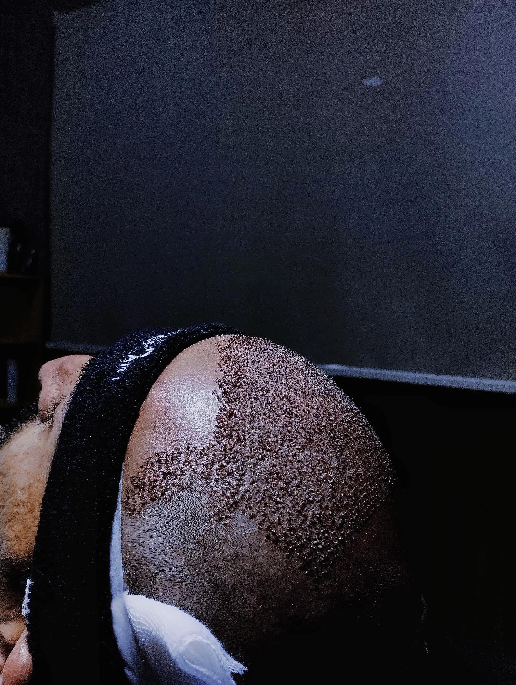 @Dr Ihsan Hair Transplant