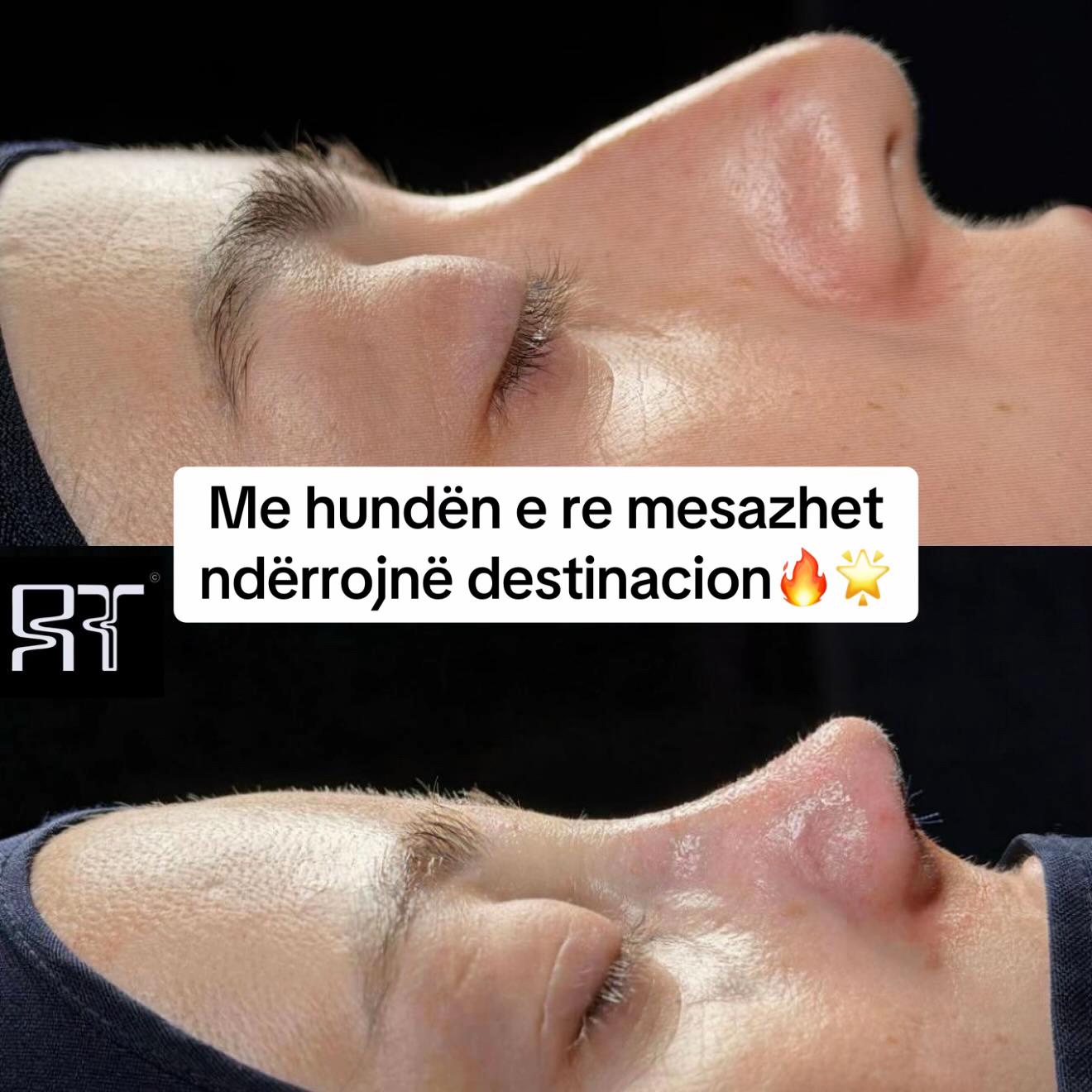 @rinoplasticatirana