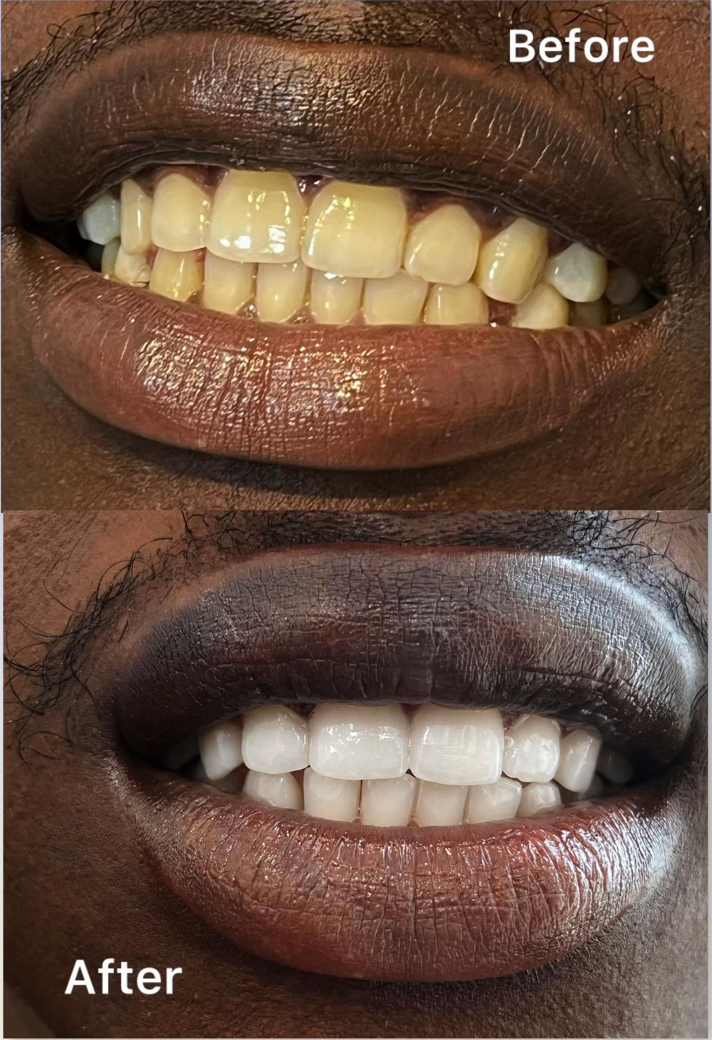 @Whiten Lighten TAC