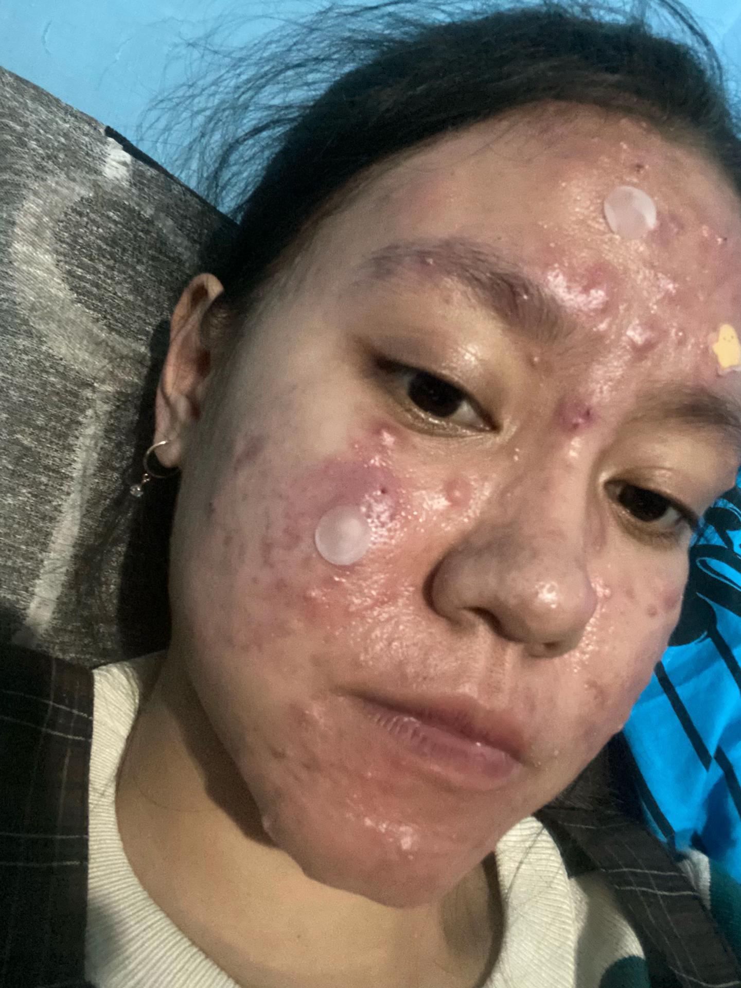 @Ichaa | acnefighter