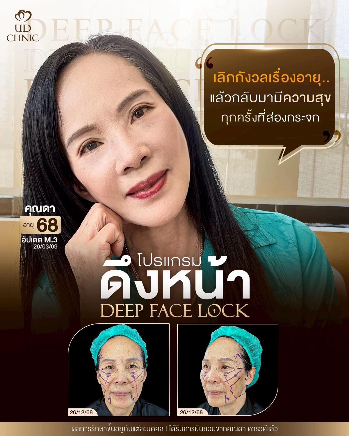 @ดึงหน้า ud clinic
