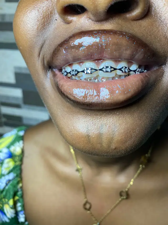 @Braces.bymavi|Smile Aesthetics