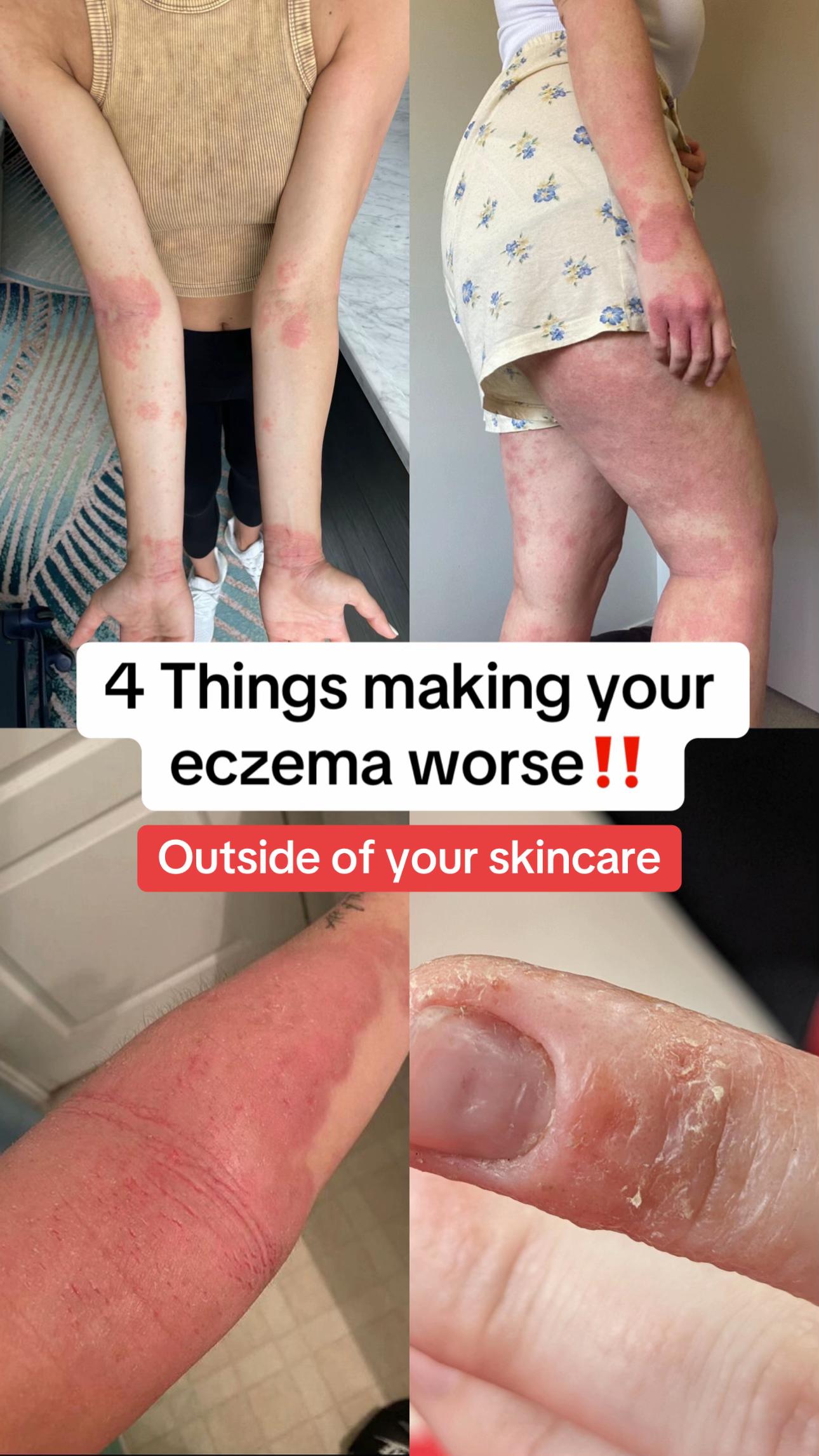 @Eczema Diaries USA & UK