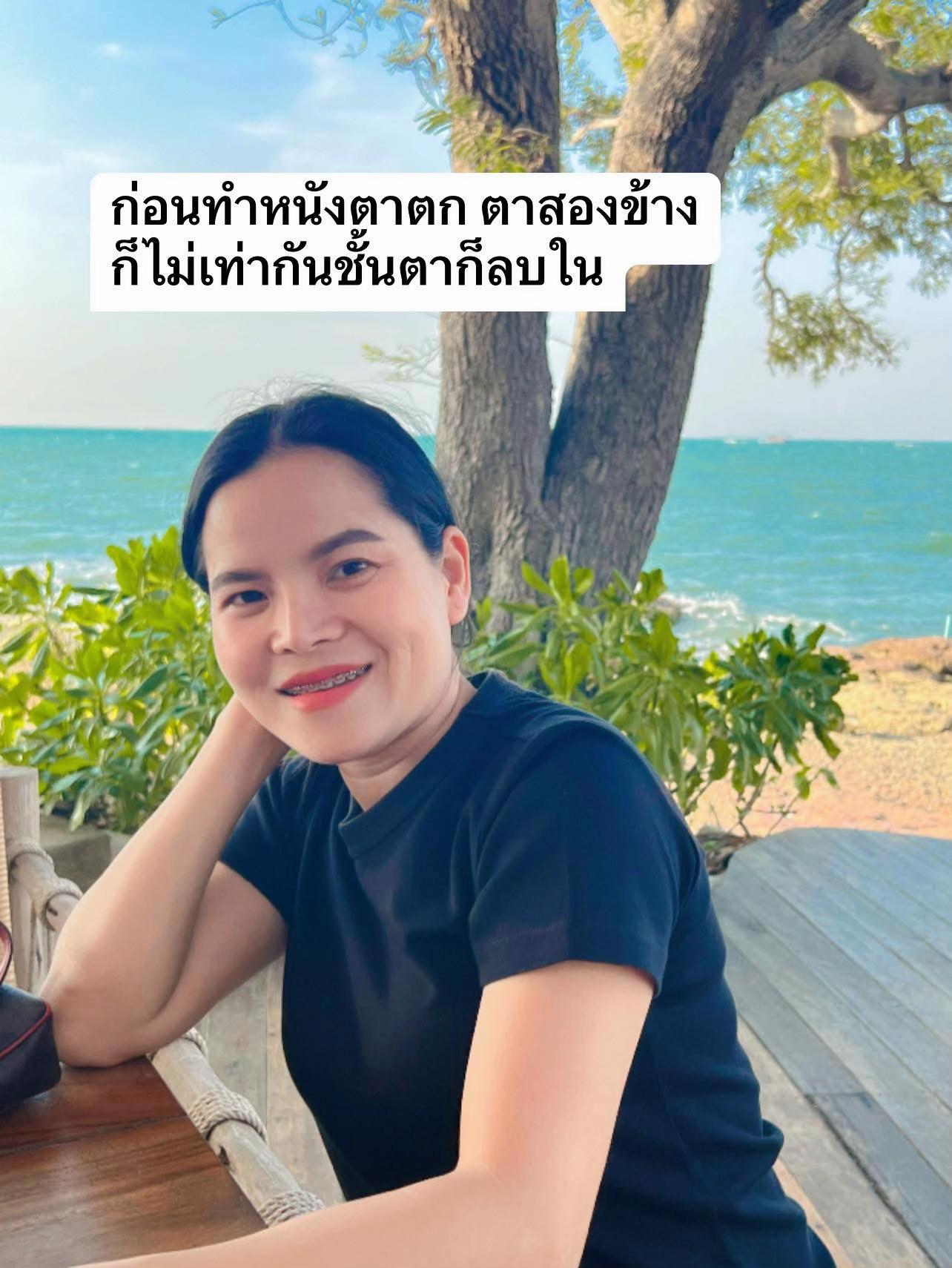 @เวลาคลินิก ตาสองชั้น ถุงใต้ตา