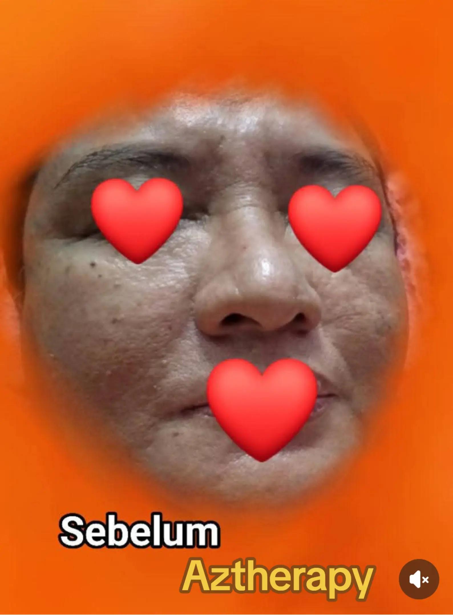 @AzTherapy Perawat Lin