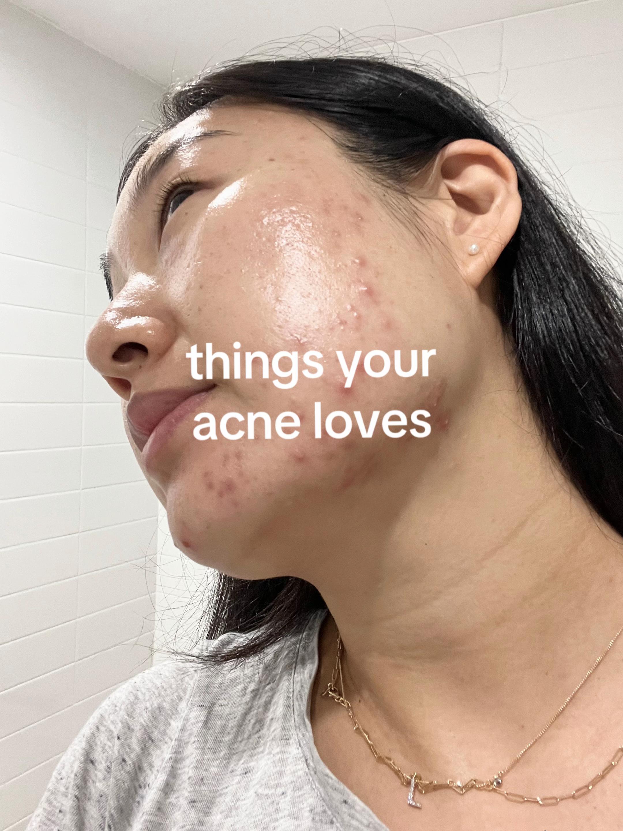 @Lisa | acne &rarr; clear skin