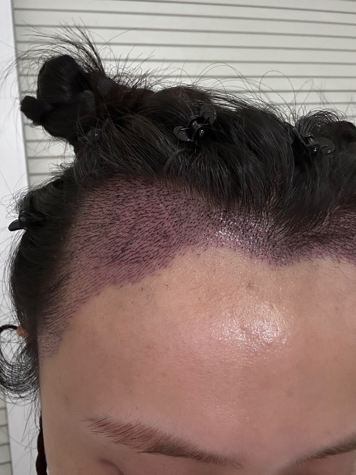 @HAIR TRANSPLANT WANG🇨🇳