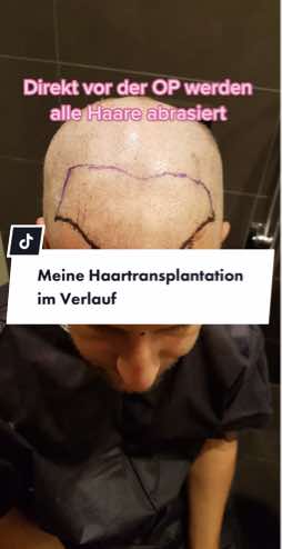 @Mr. Hairtransplant
