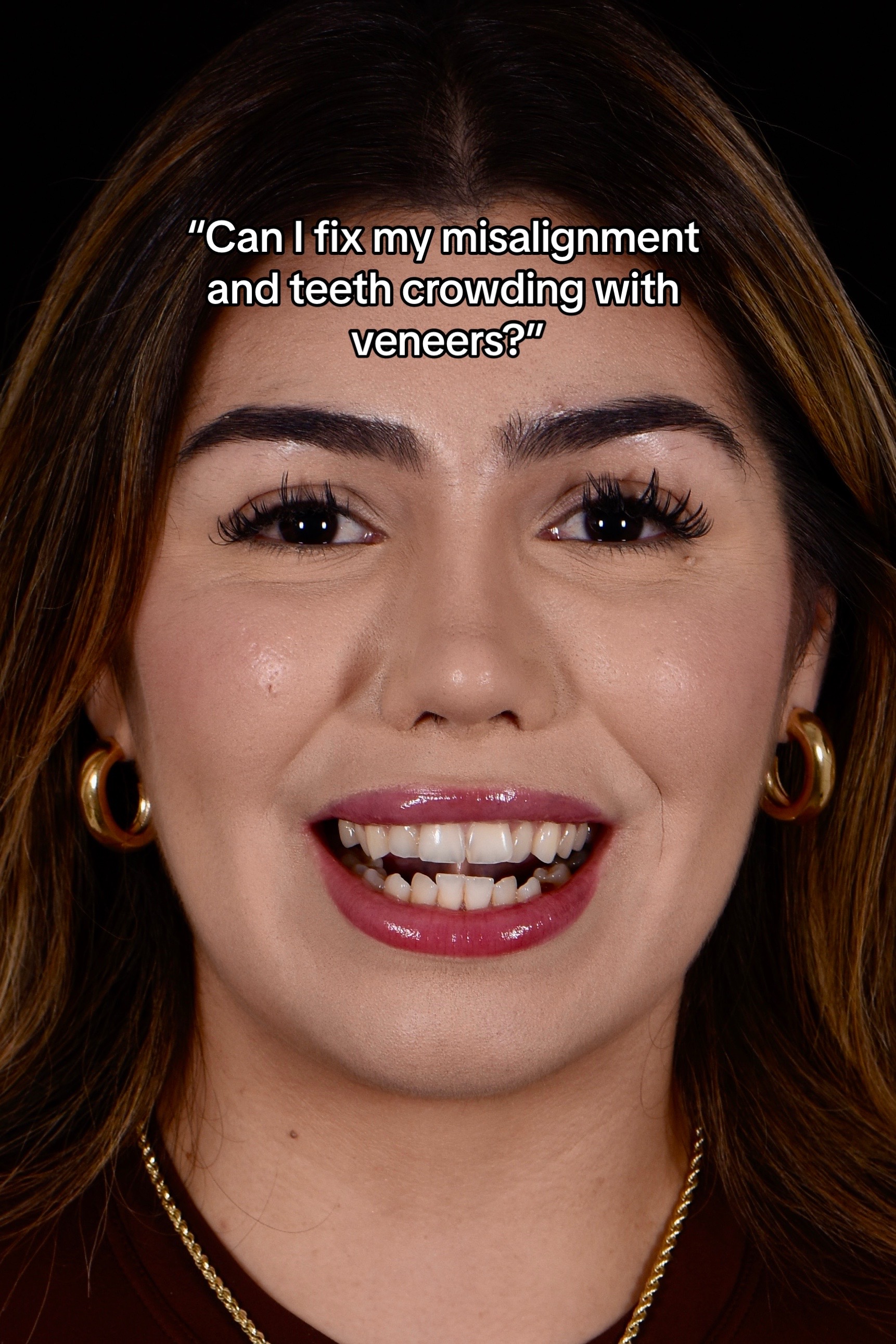 @Veneers