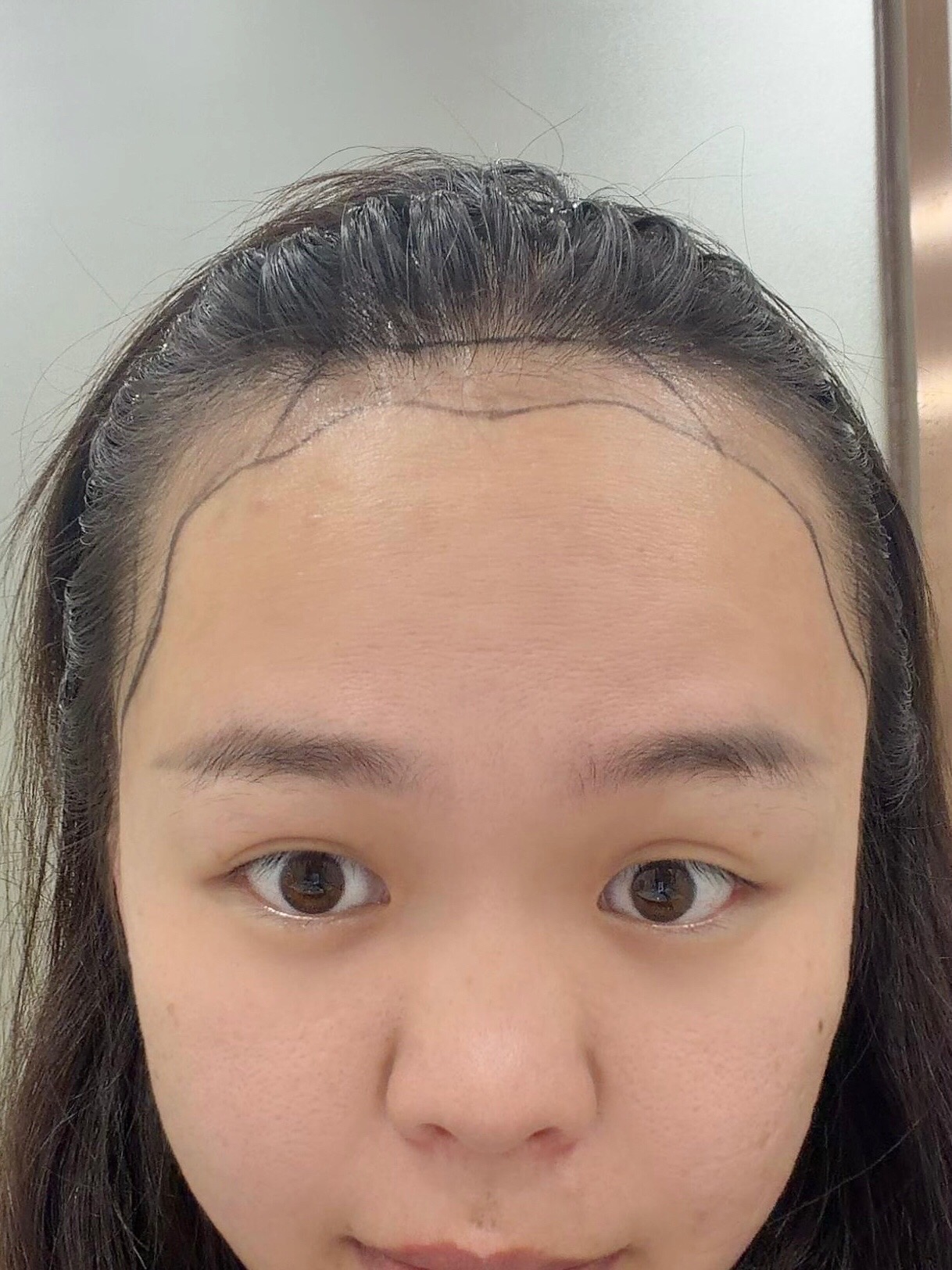 @HAIR TRANSPLANT WANG🇨🇳
