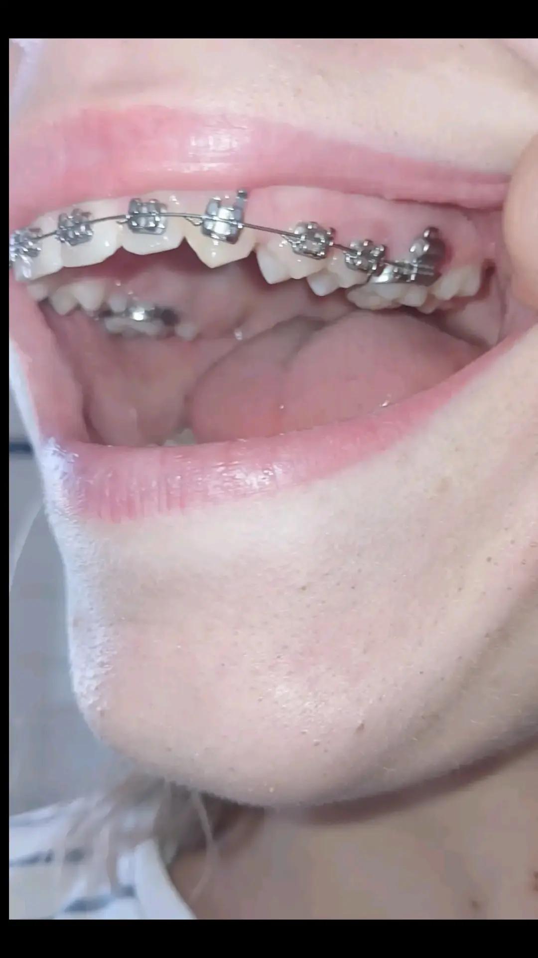 @Zahnspangen Club/  Braces Site