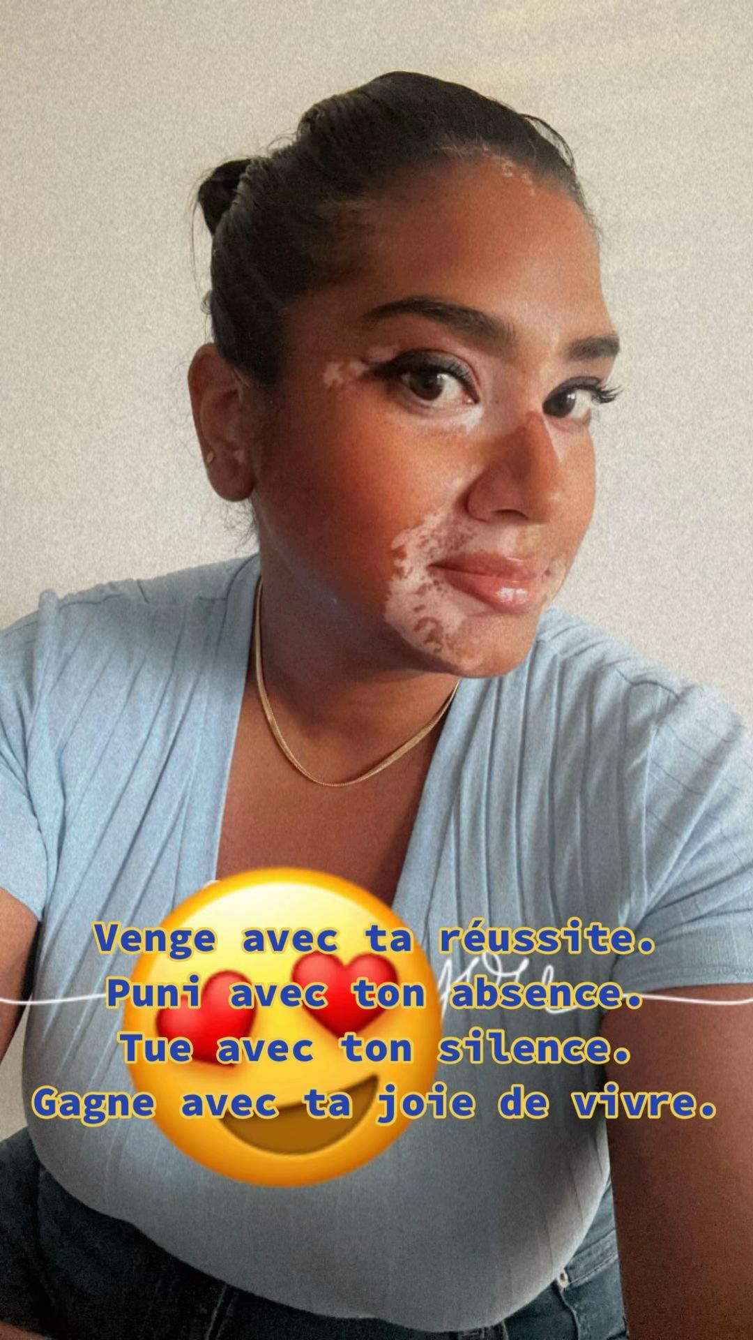 @Mimie | Vitiligo 🤍🌸
