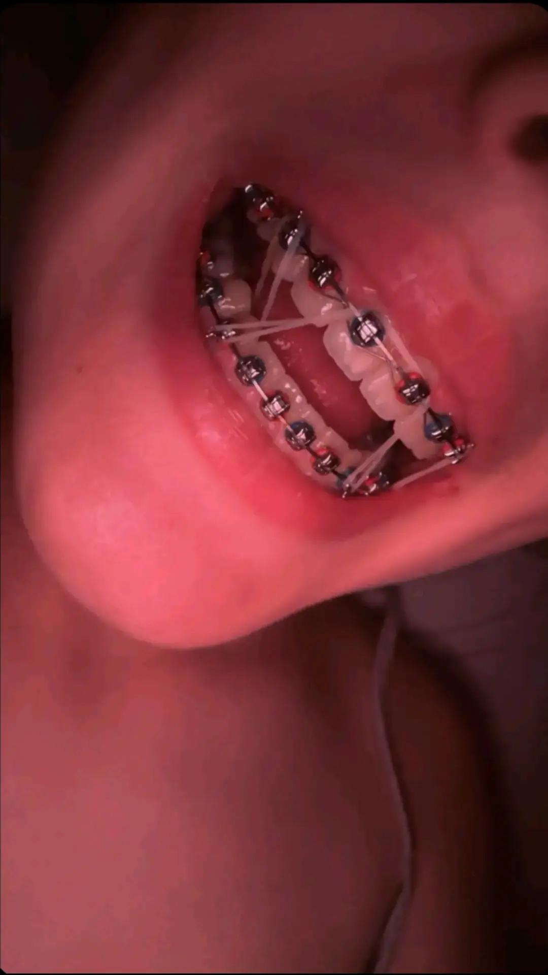 @Zahnspangen Club/  Braces Site