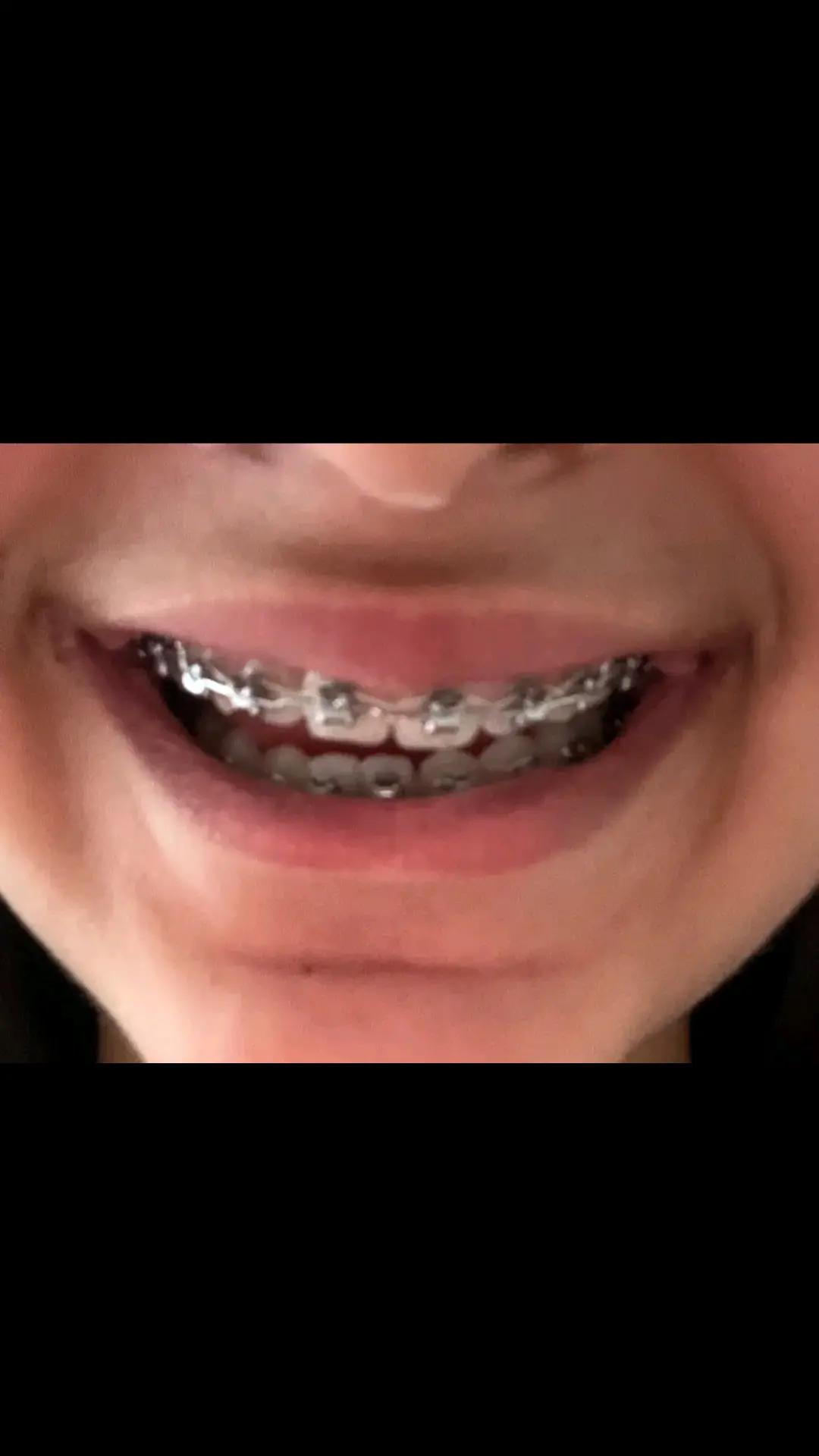 @Zahnspangen Club/  Braces Site