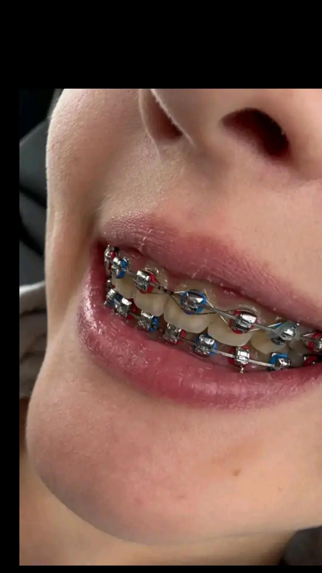 @Zahnspangen Club/  Braces Site