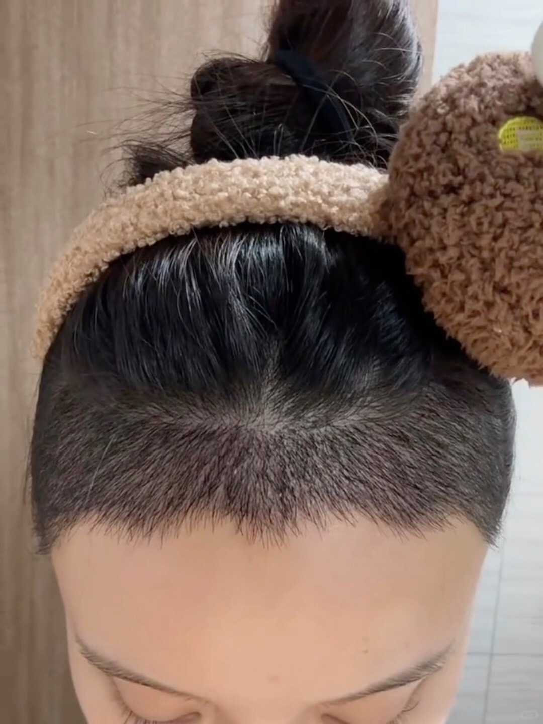 @HAIR TRANSPLANT WANG🇨🇳