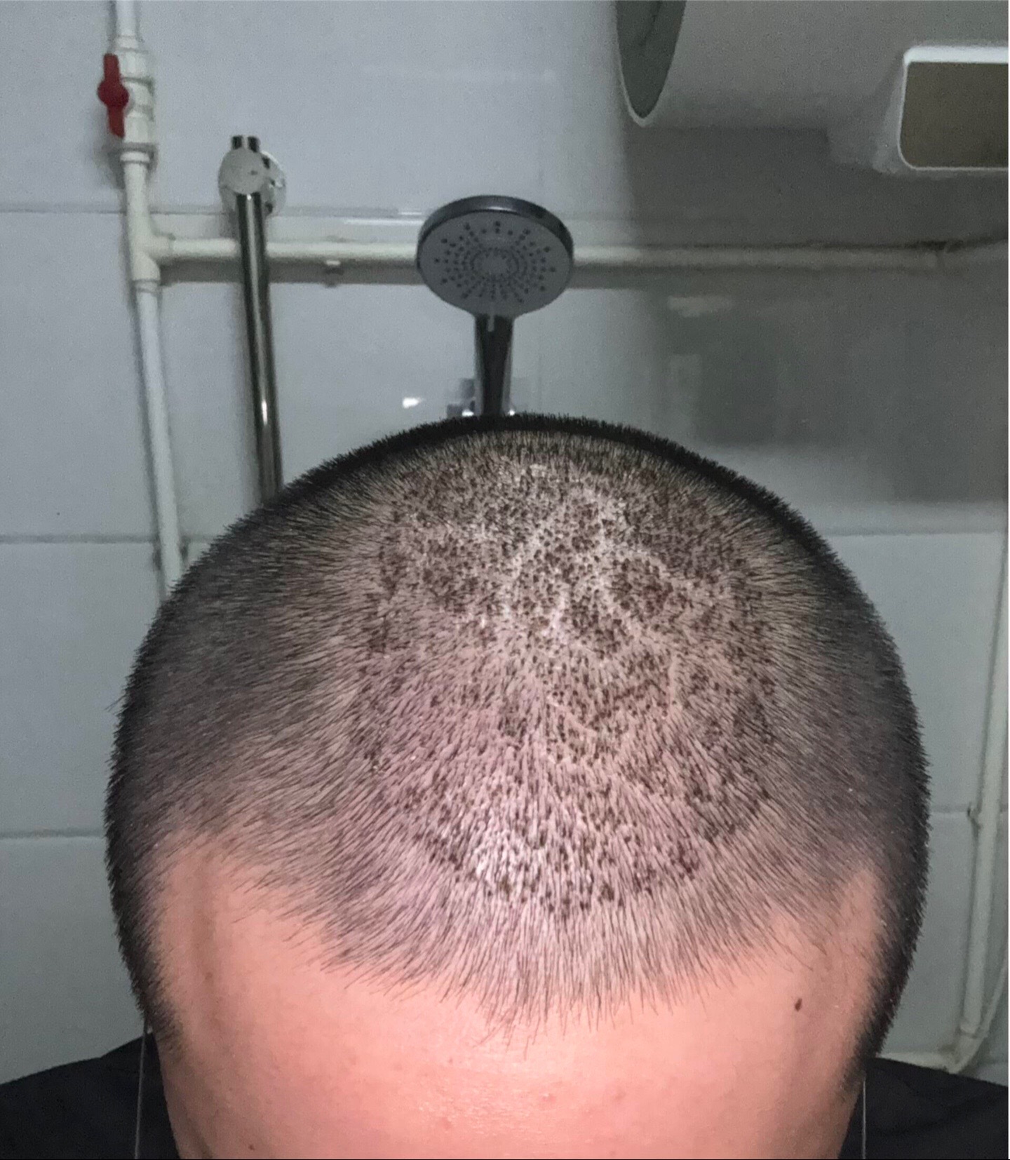 @HAIR TRANSPLANT WANG🇨🇳