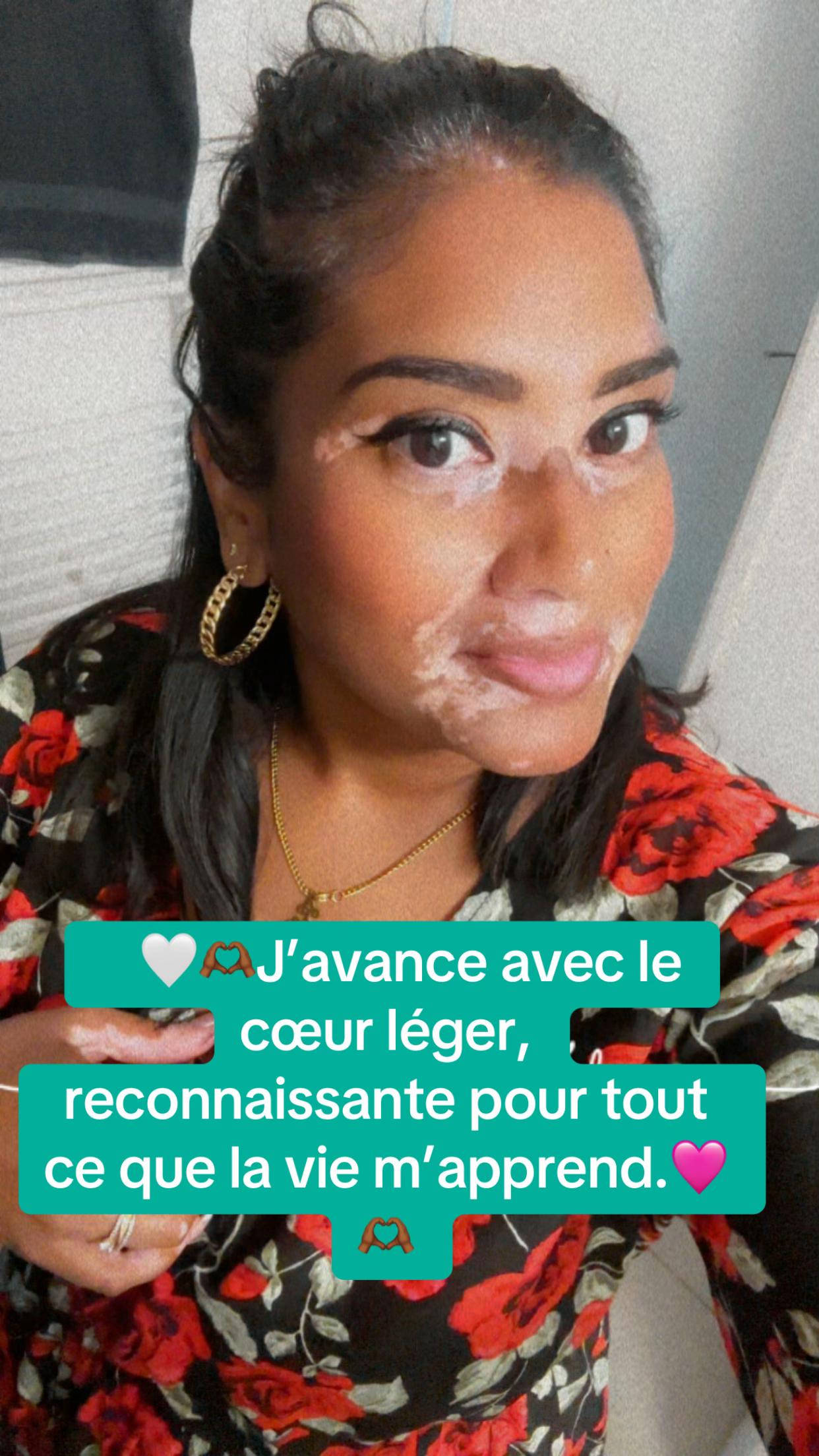 @Mimie | Vitiligo 🤍🌸