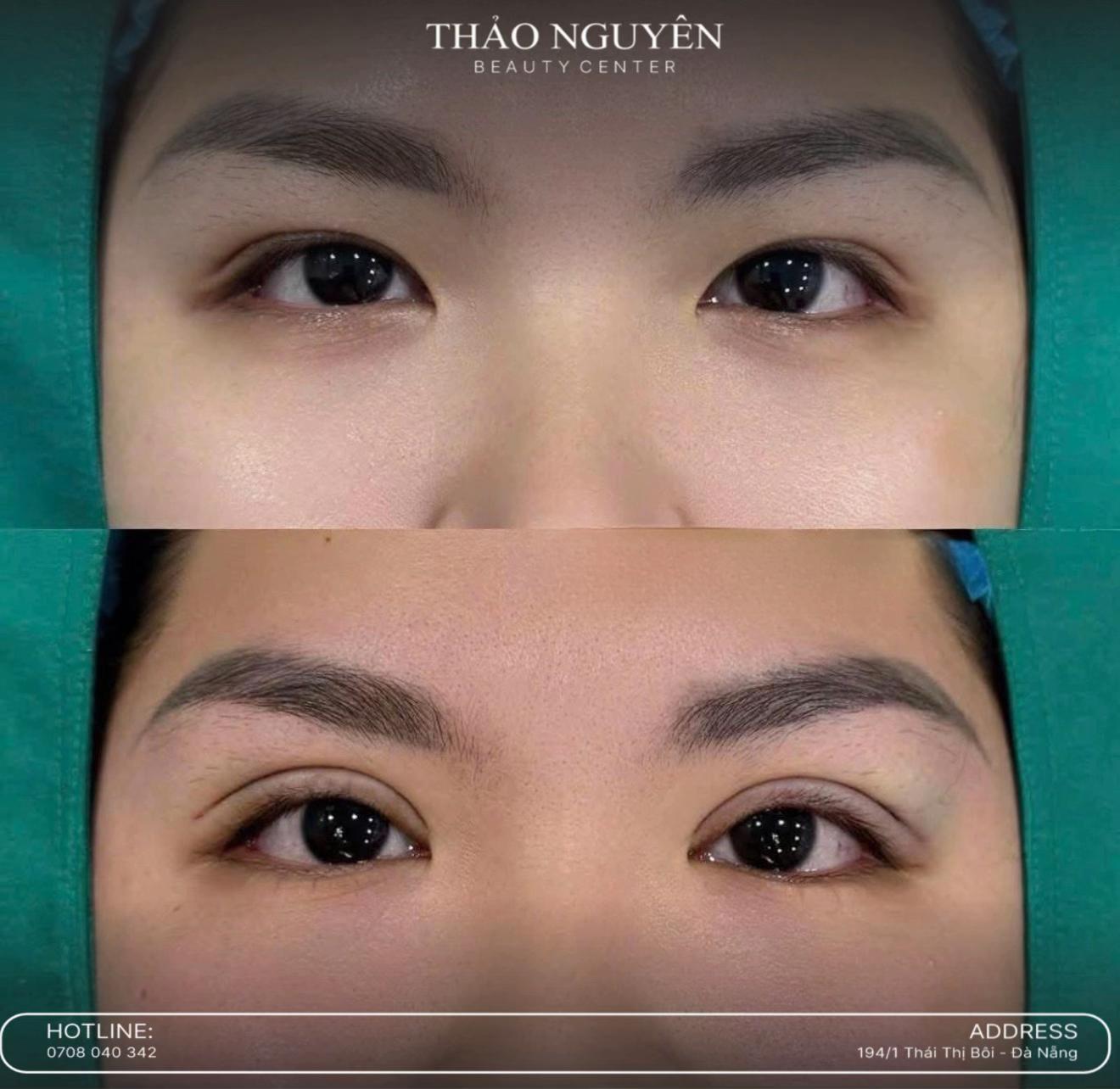@TN - Filler Botox Đà Nẵng