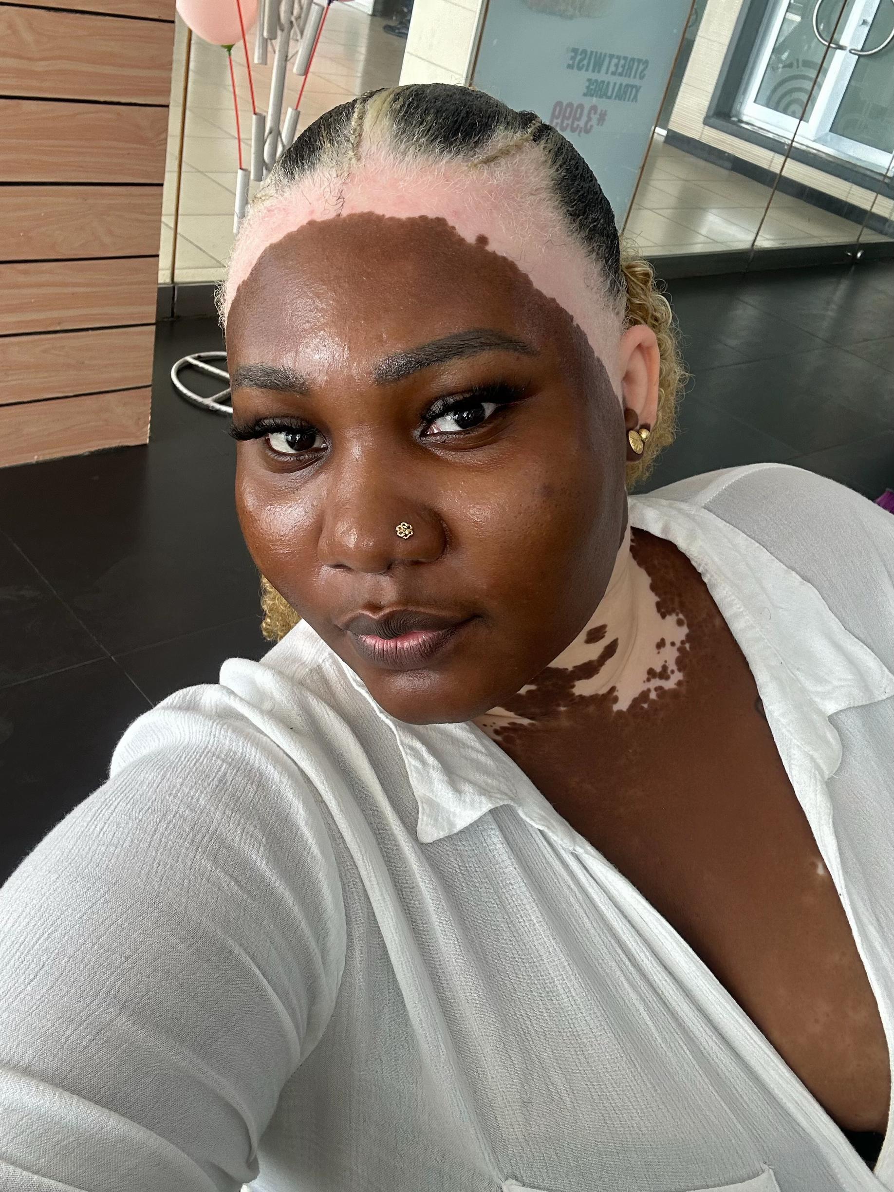 @Thevitiligogirl