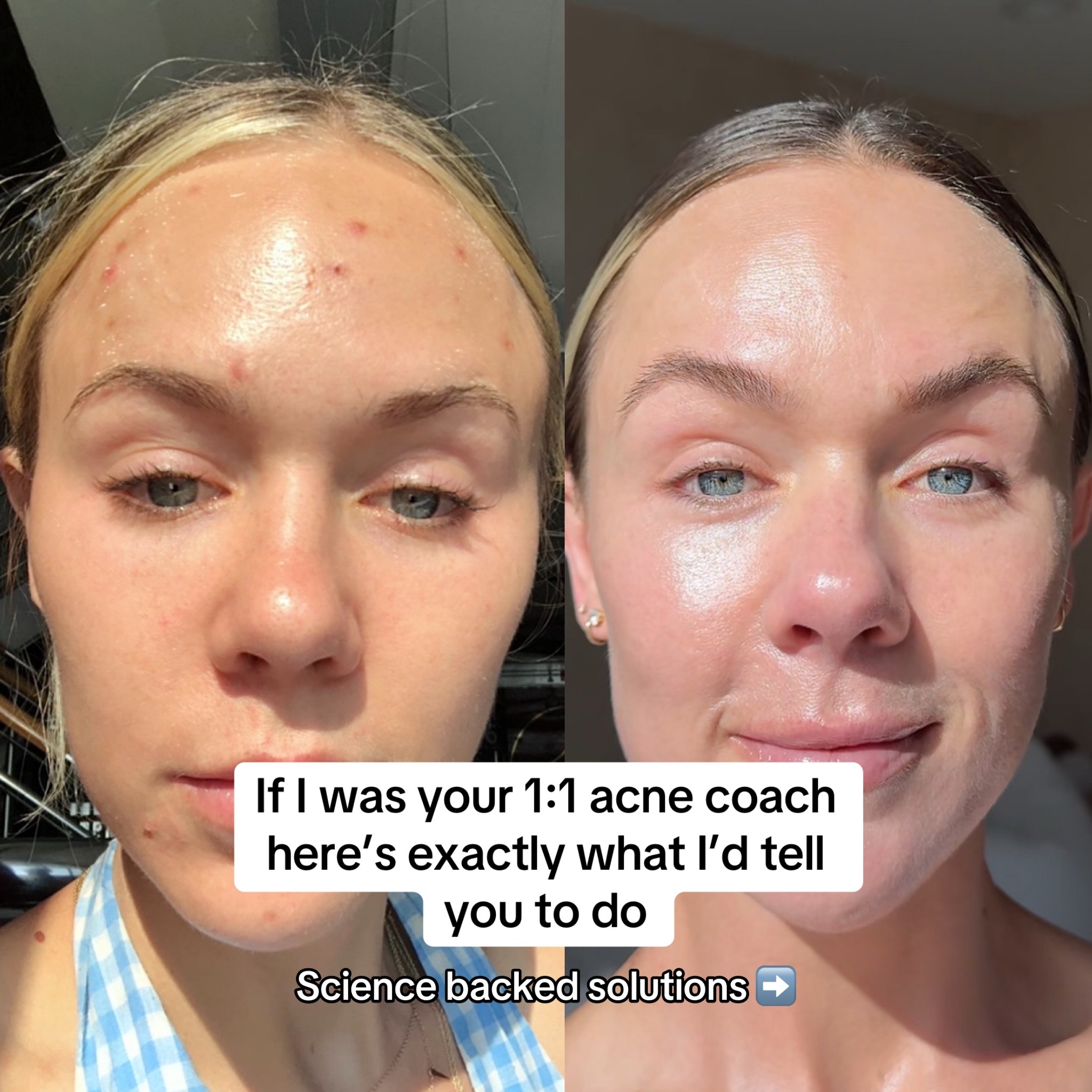 @Celeste | RN acne expert