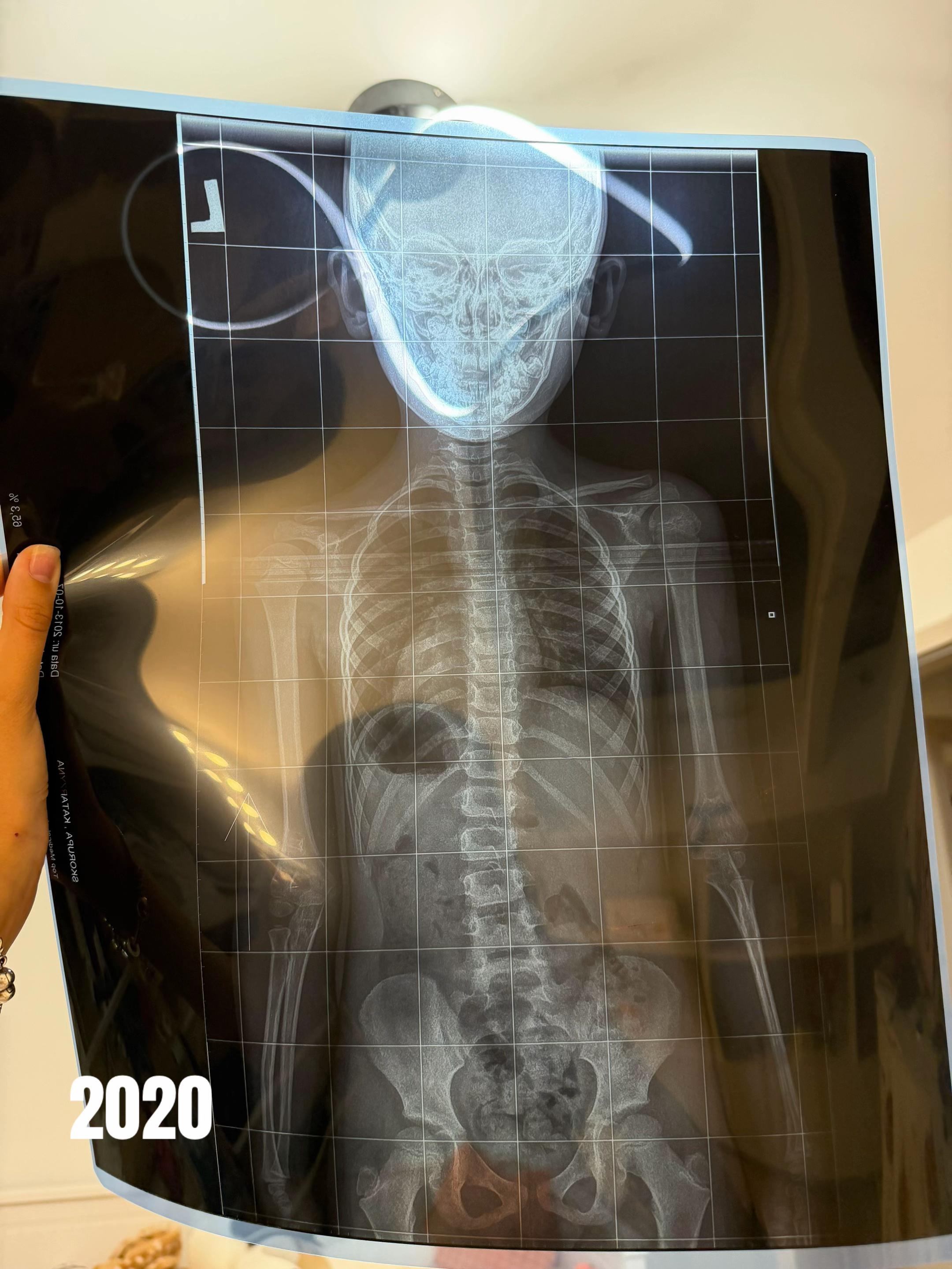 @Twin.withscoliosis🩻🪽💋