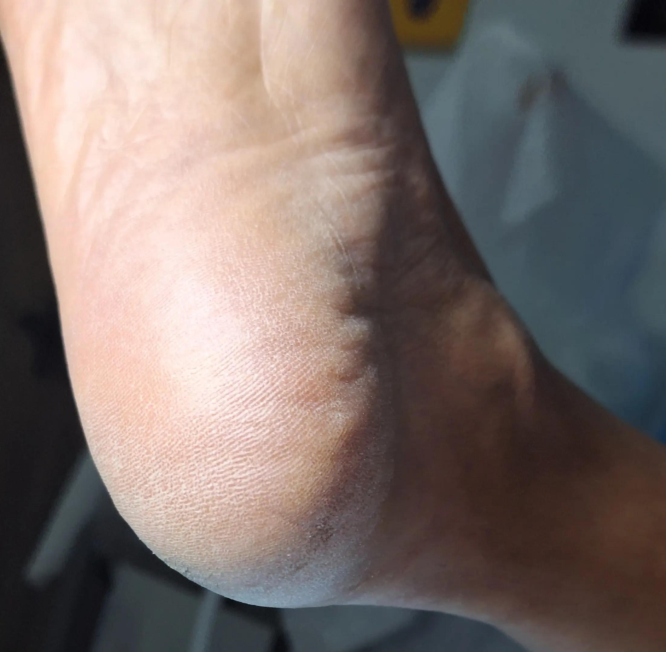 @Quiropodia HAPPY FOOT🇨🇷