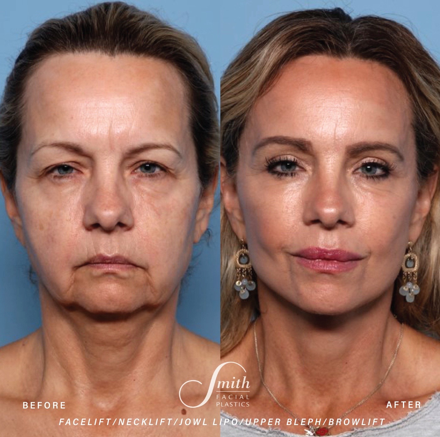 @Smith Facial Plastics