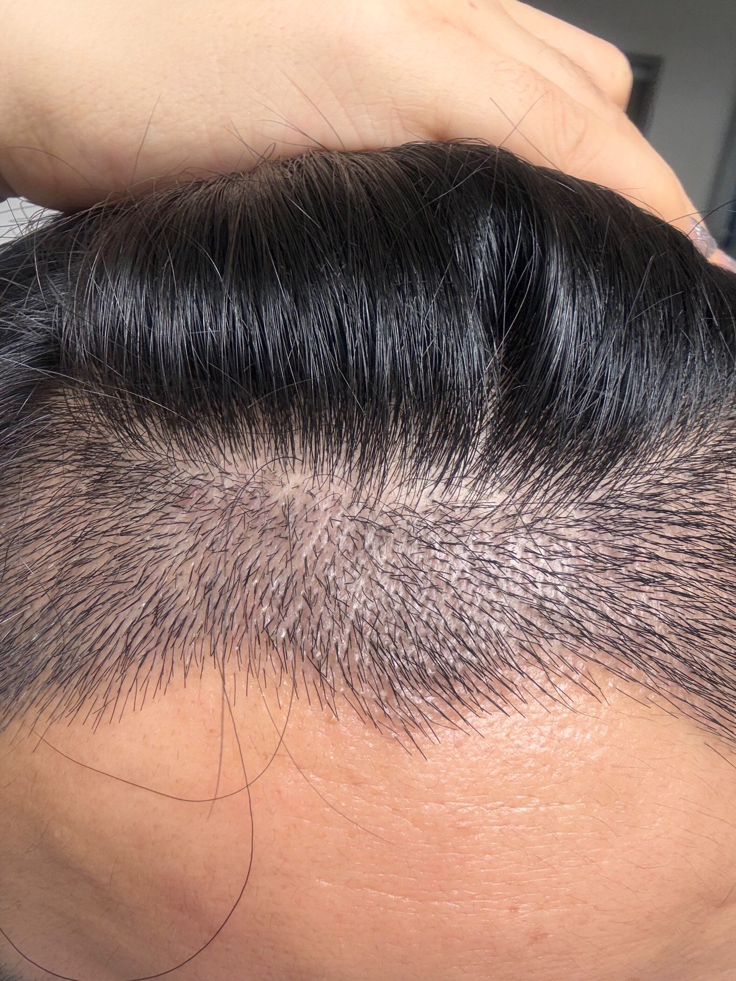 @HAIR TRANSPLANT WANG🇨🇳