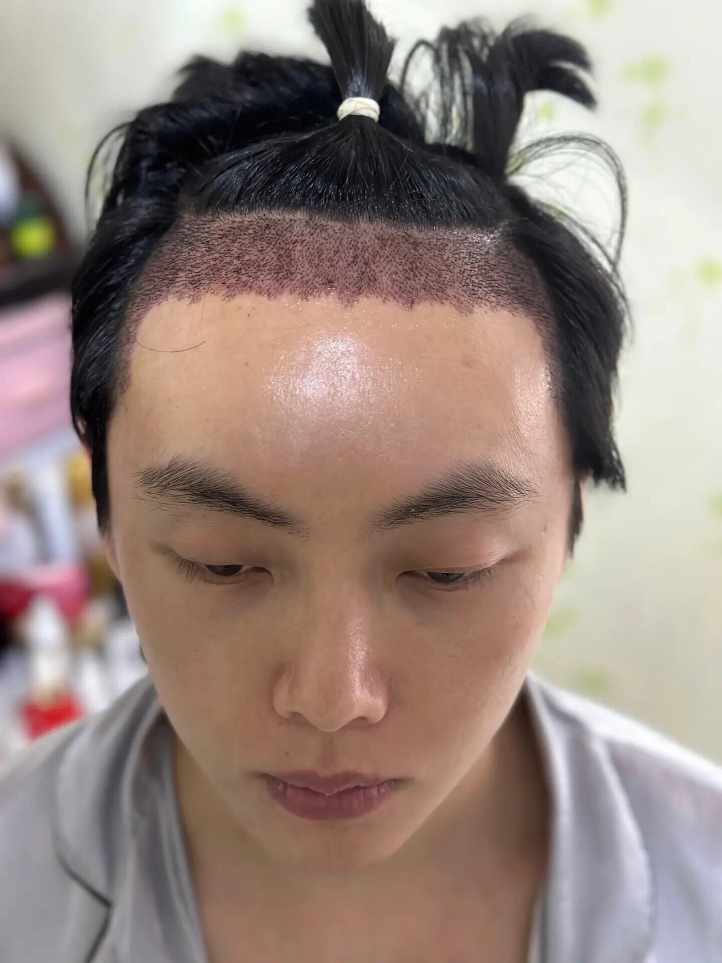 @HAIR TRANSPLANT WANG🇨🇳