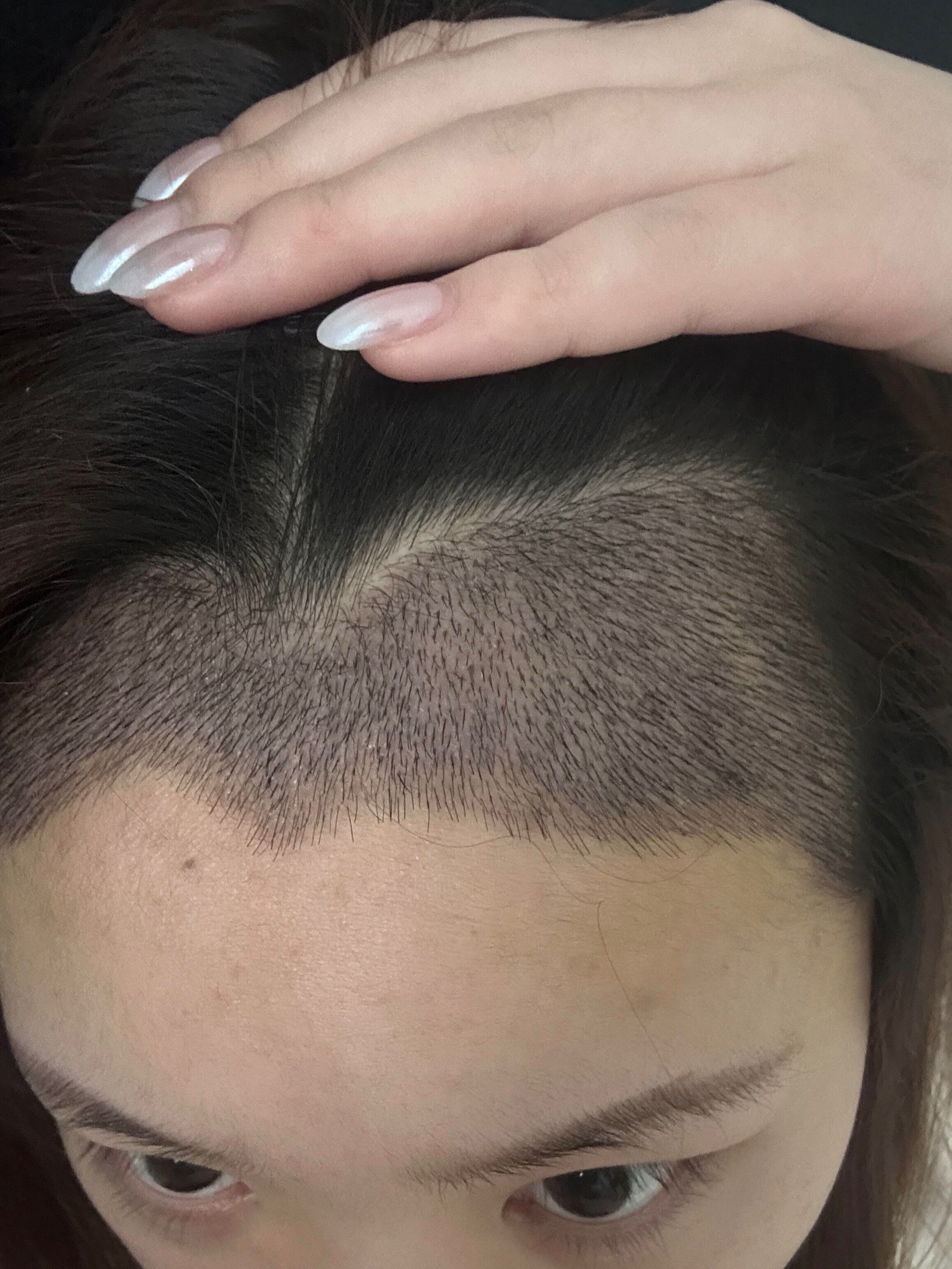 @HAIR TRANSPLANT WANG🇨🇳