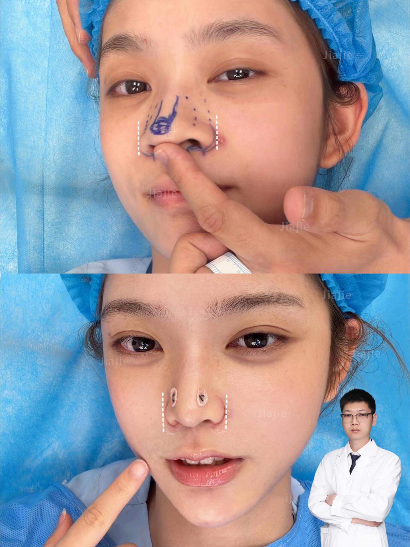 @Nose augmentation