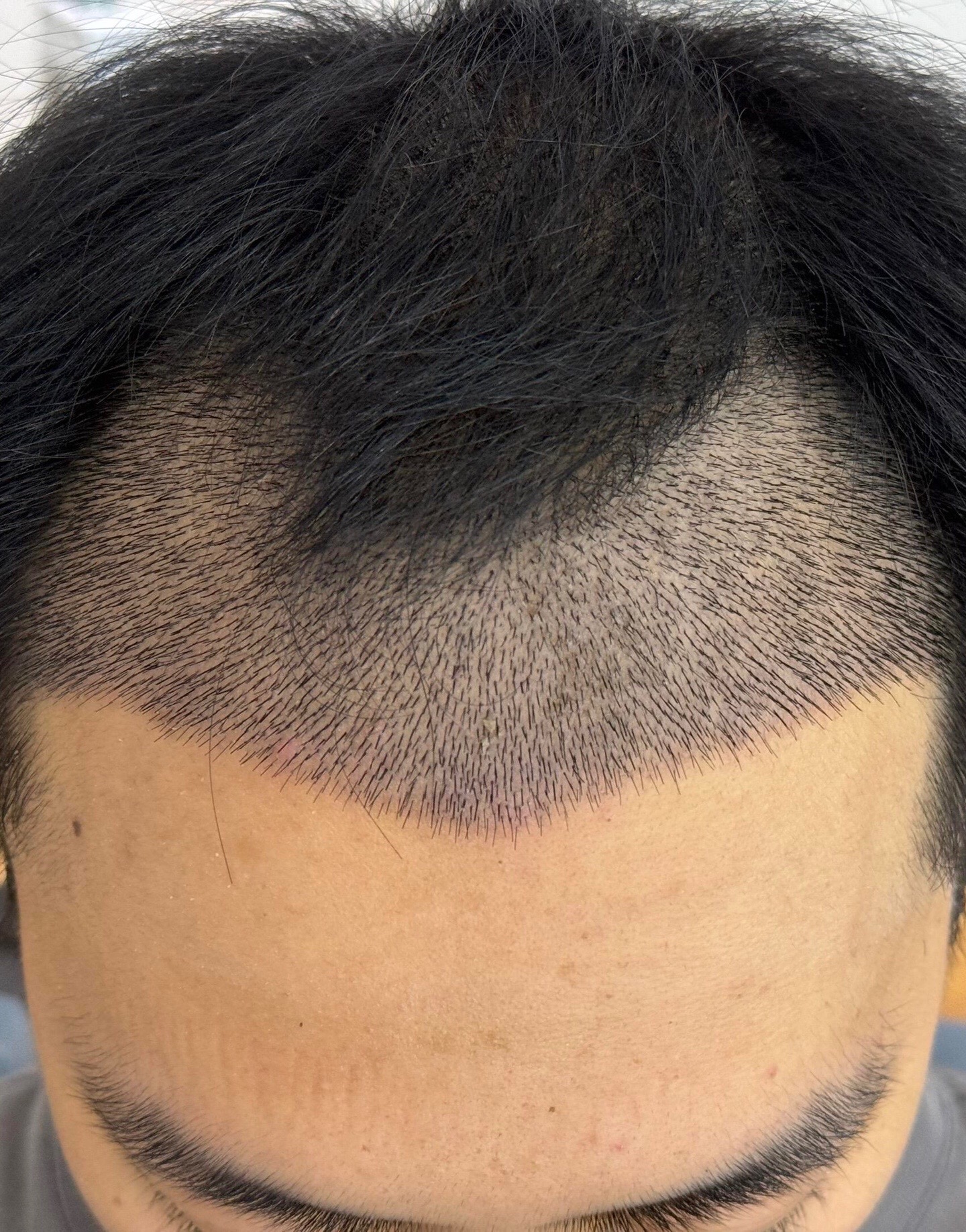 @HAIR TRANSPLANT WANG🇨🇳