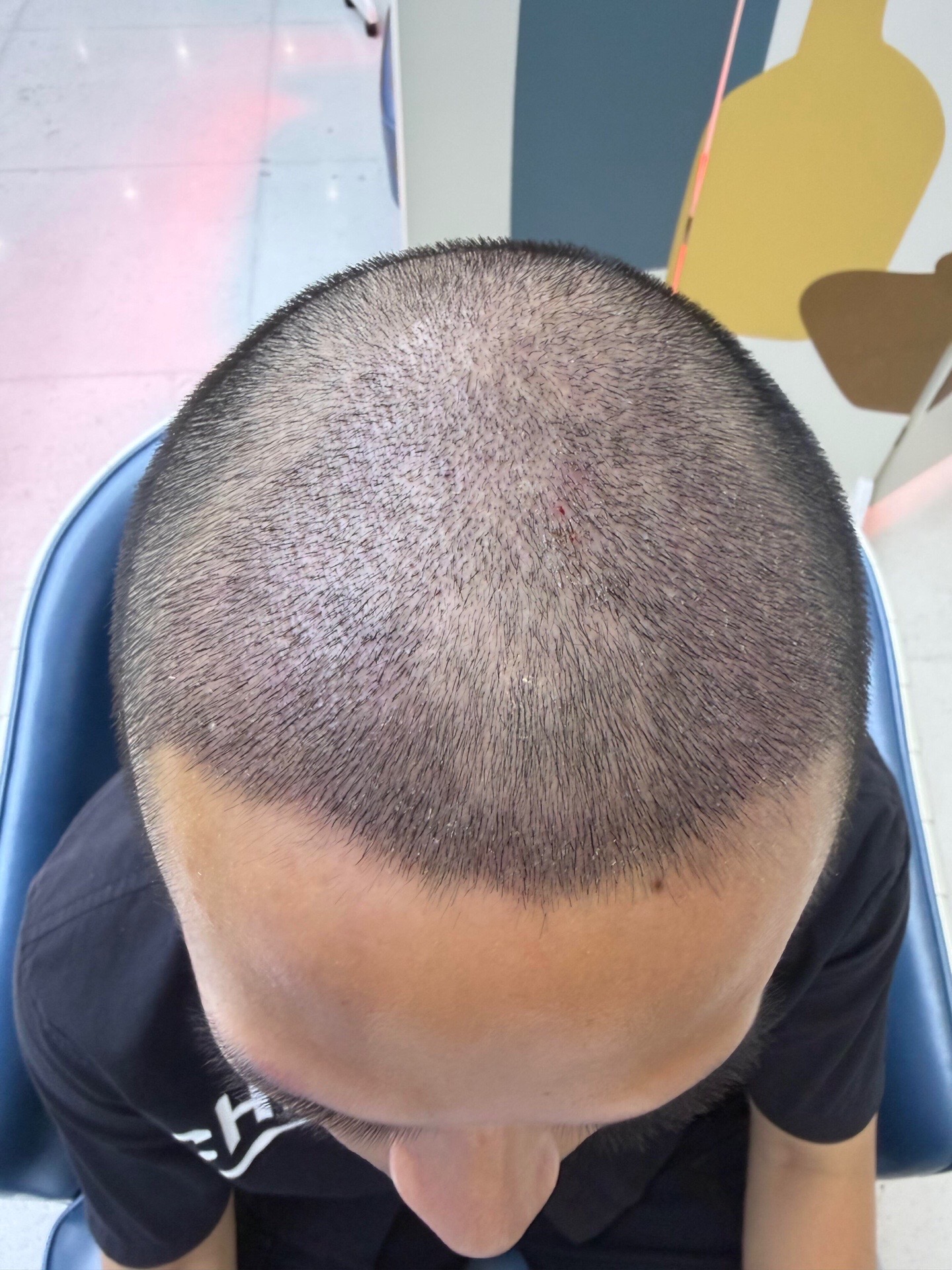 @HAIR TRANSPLANT WANG🇨🇳