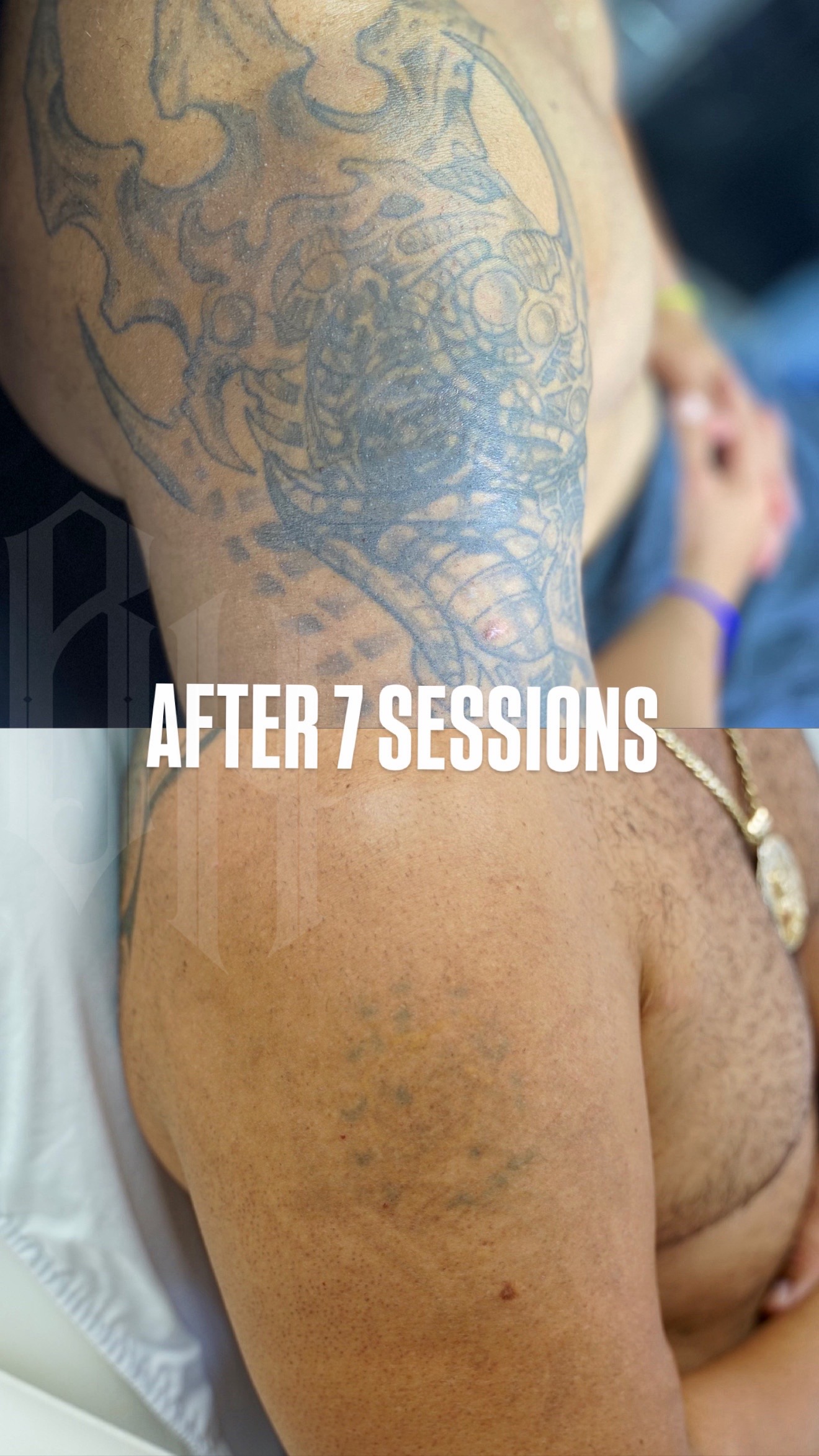 @@BHLASERTATTOOREMOVAL