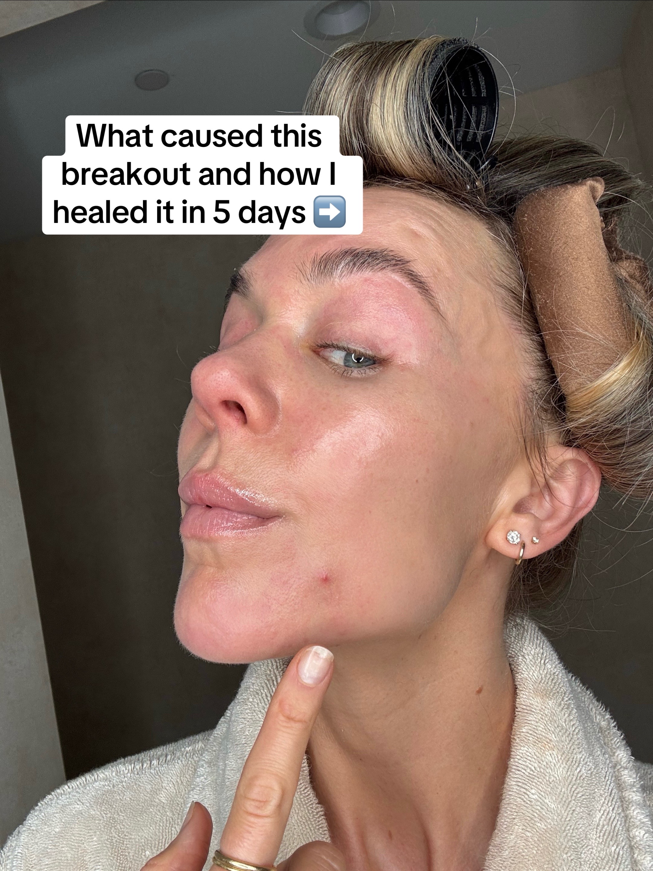 @Celeste | RN acne expert