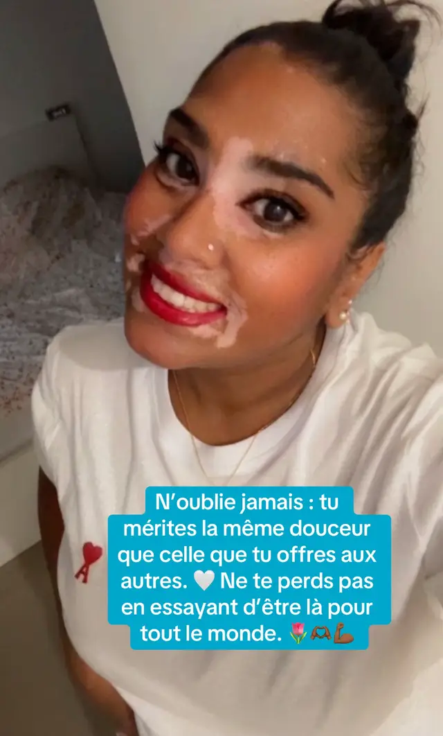 @Mimie | Vitiligo 🤍🌸