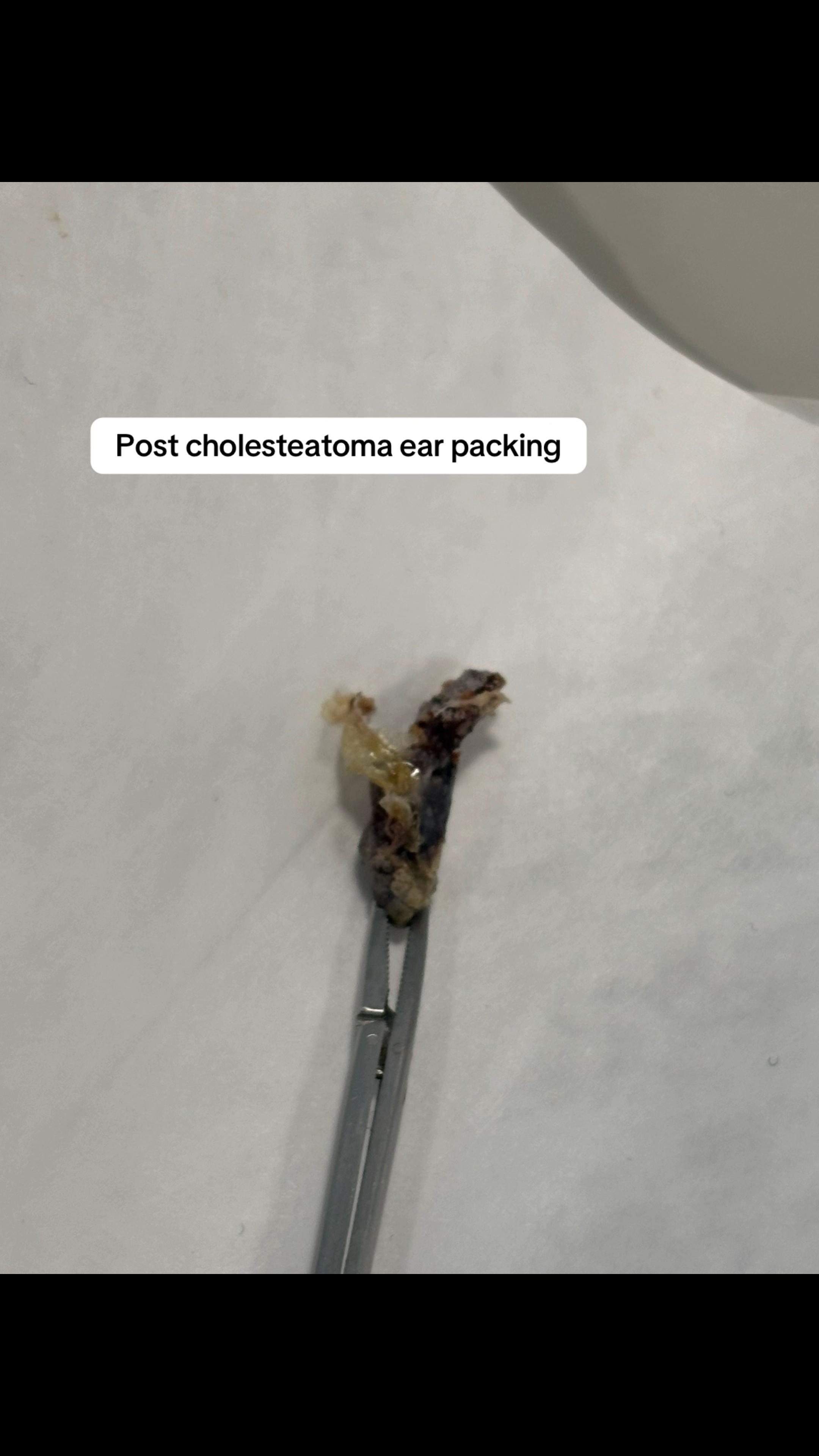 @cholesteatoma.chrissy