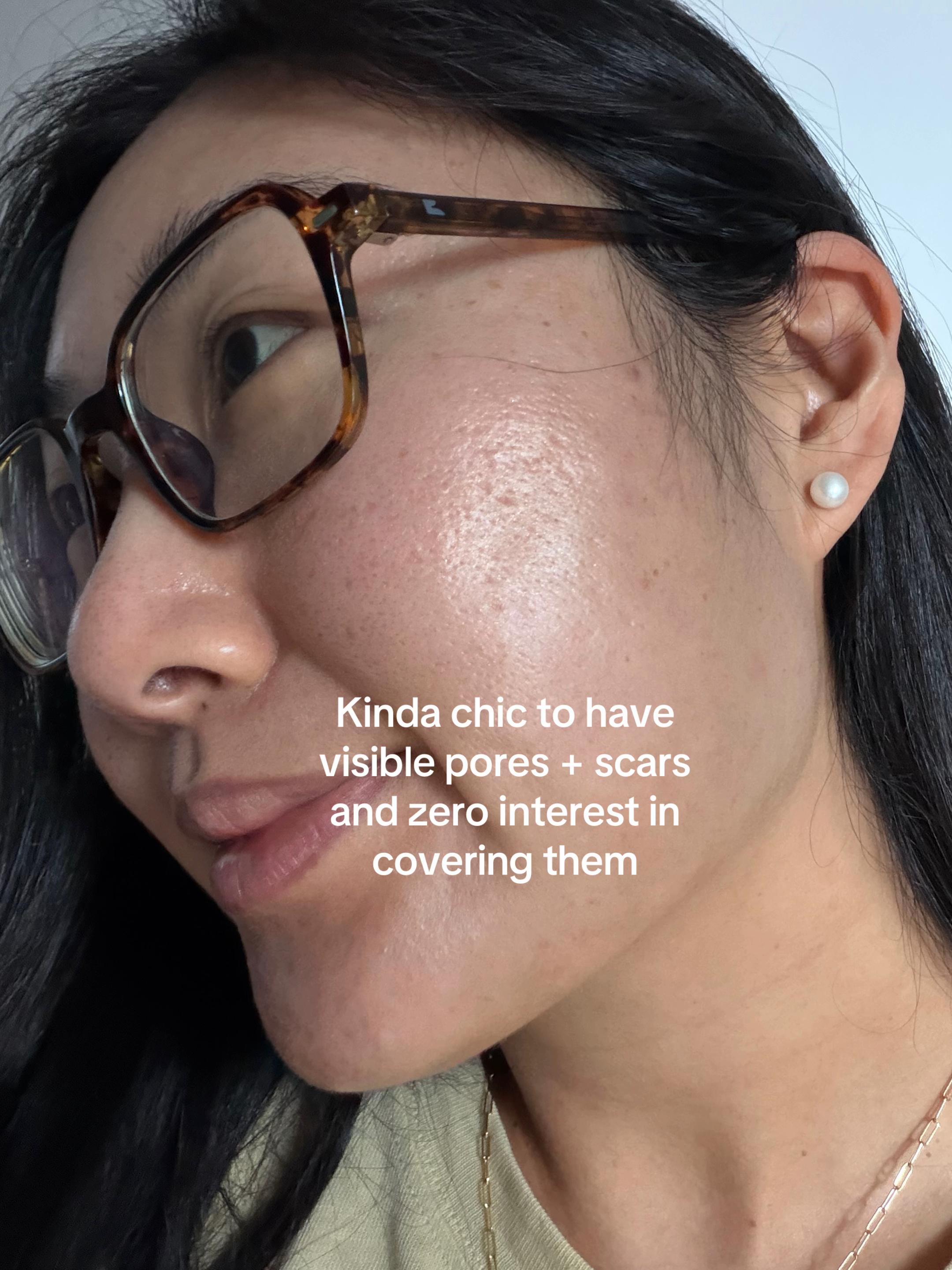 @Lisa | acne &rarr; clear skin