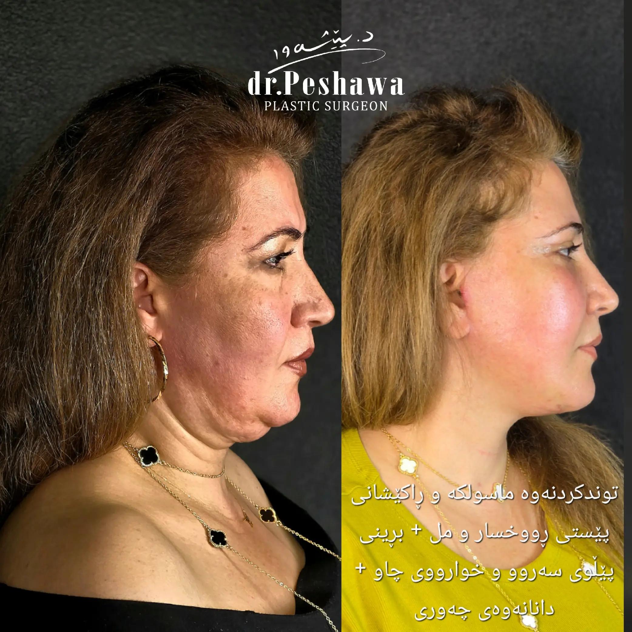 @Dr. Peshawa Plastic Surgeon