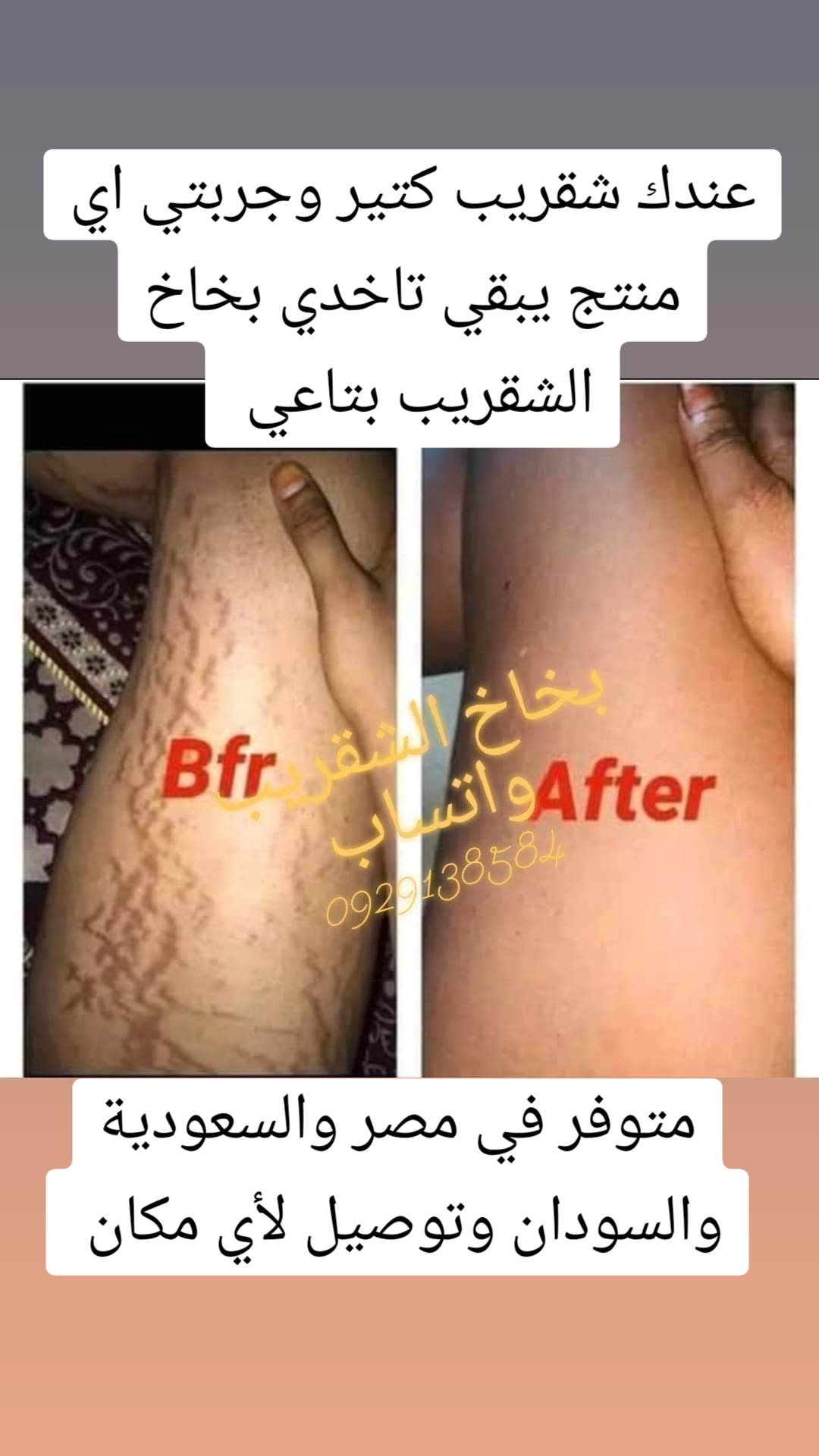 @drmanal " لعلاج التشققات "