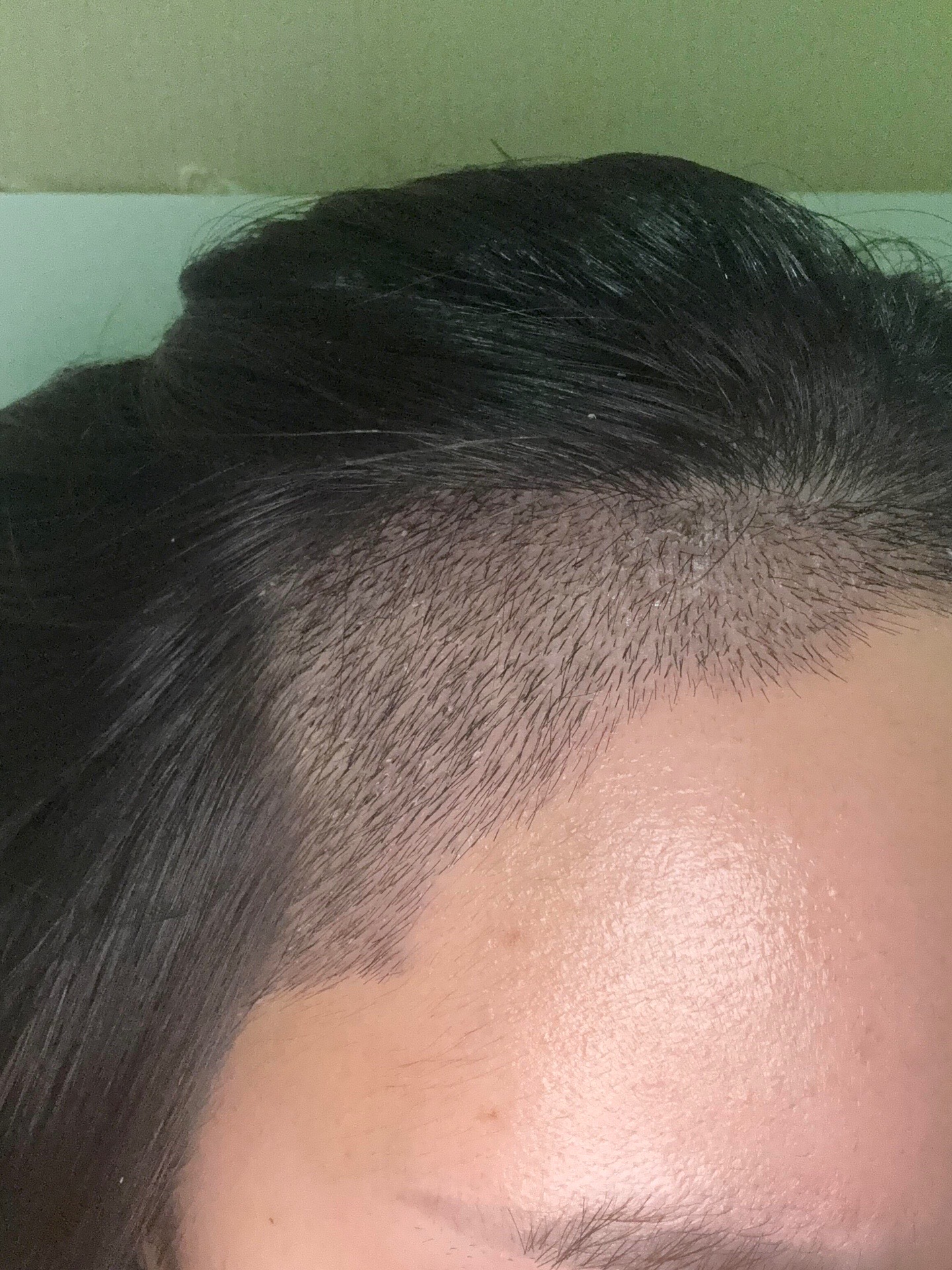 @HAIR TRANSPLANT WANG🇨🇳