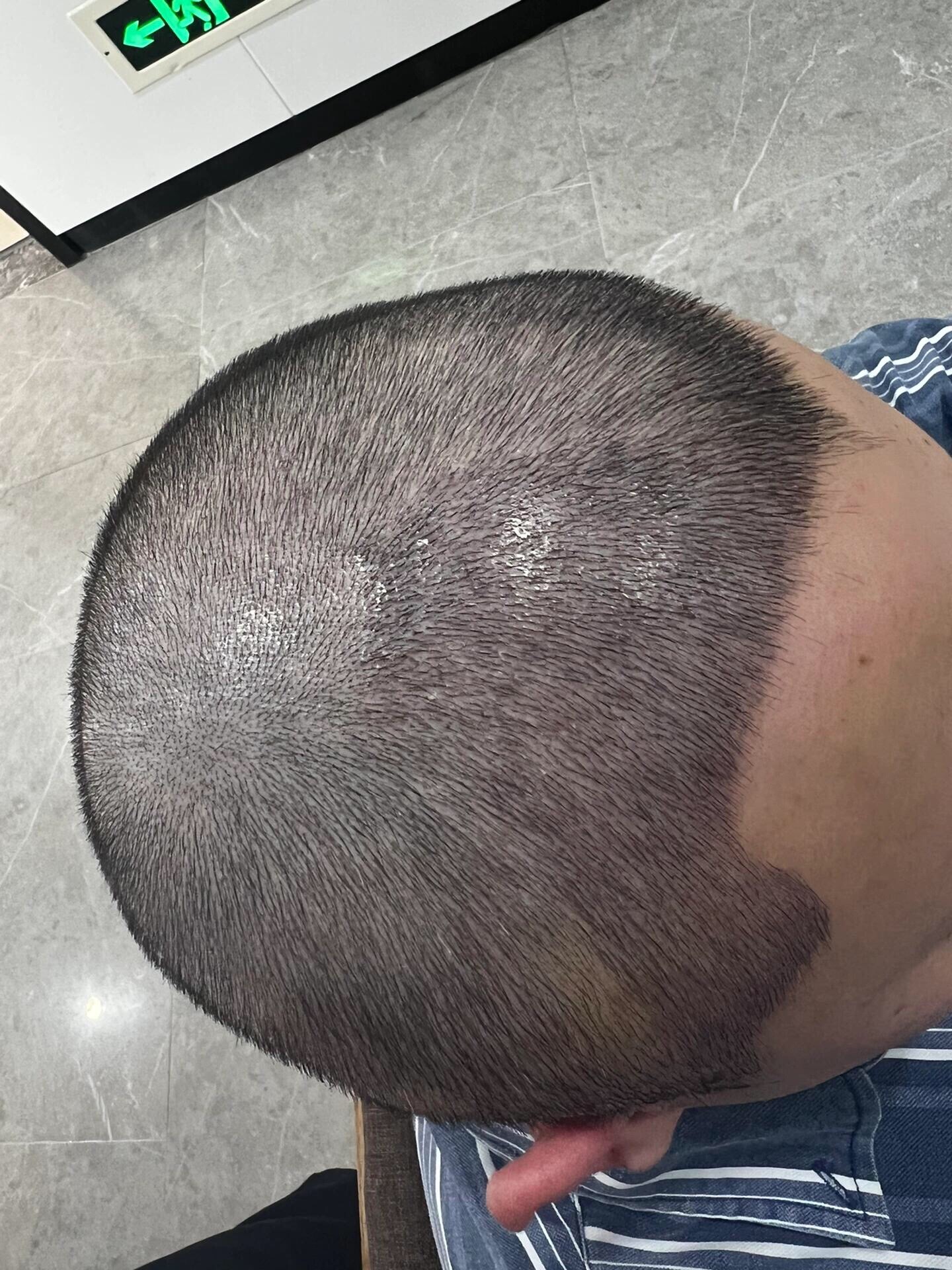 @HAIR TRANSPLANT WANG🇨🇳
